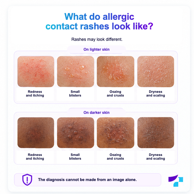 What allergic contact rashes look like Signs of allergic contact rash on different skin tones