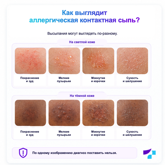 Как выглядит аллергическая контактная сыпь Признаки аллергической контактной сыпи на разных оттенках кожи