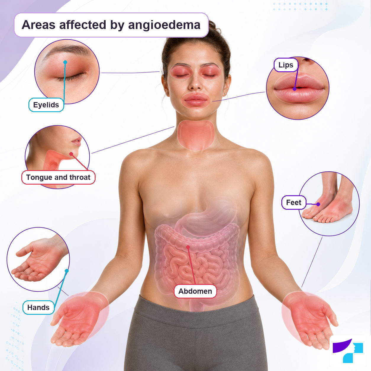 Areas affected by angioedema: eyelids, lips, tongue and throat, hands, feet and abdomen