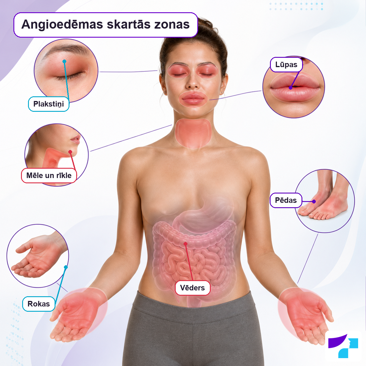 Angioedēmas skartās zonas: plakstiņi, lūpas, mēle un rīkle, rokas, pēdas un vēders