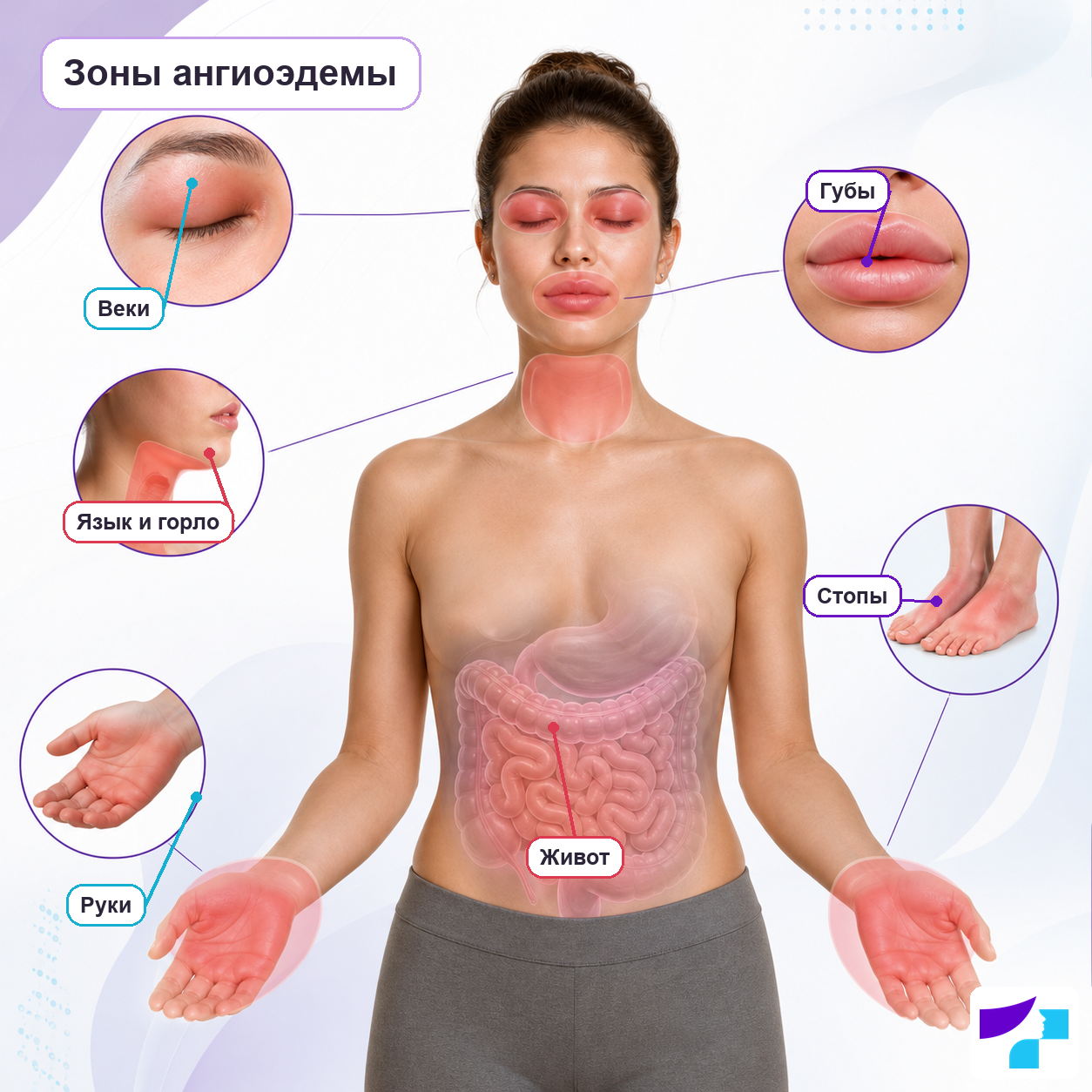 Зоны ангиоэдемы Зоны ангиоэдемы: веки, губы, язык и горло, руки, стопы и живот