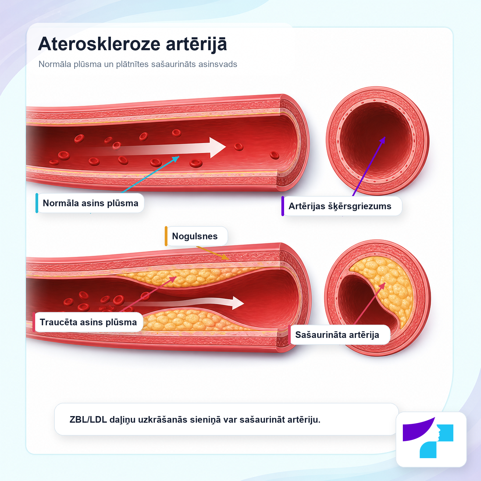 Ateroskleroze artērijā: normāla asins plūsma, nogulsnes, traucēta plūsma un sašaurināta artērija