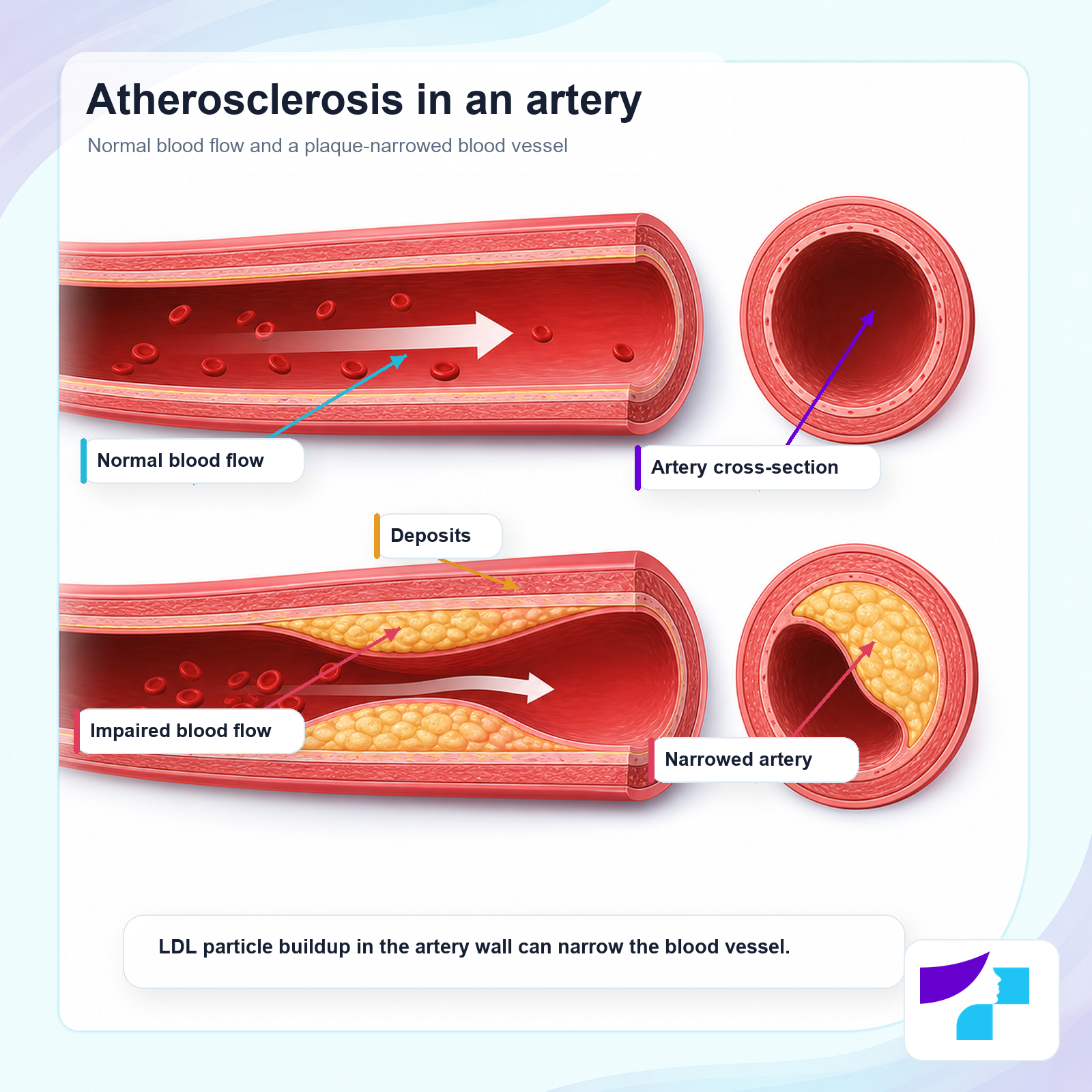 Atherosclerosis in an artery: normal blood flow, deposits, impaired blood flow and a narrowed artery