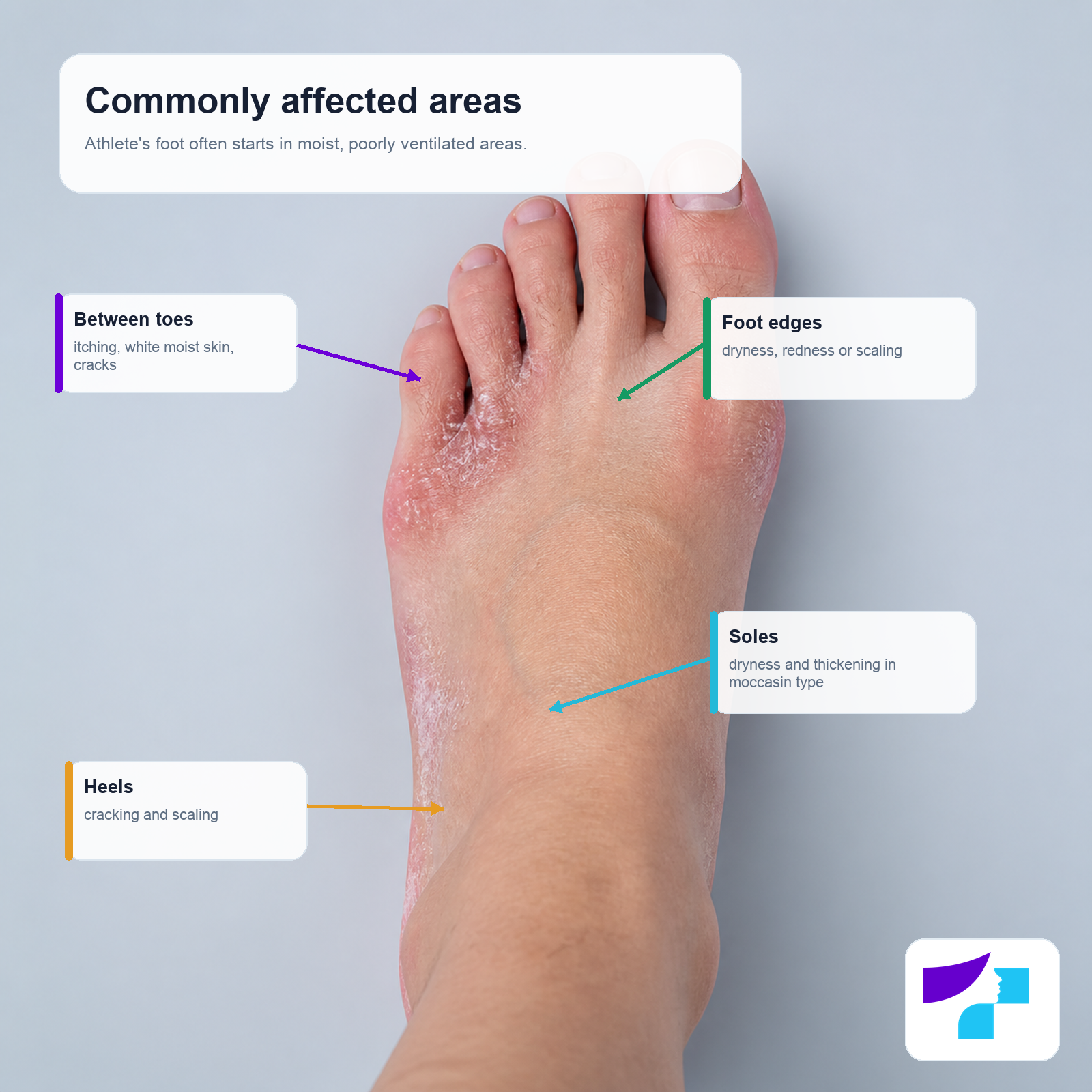 Commonly affected areas in athlete’s foot: between the toes, foot edges, soles and heels
