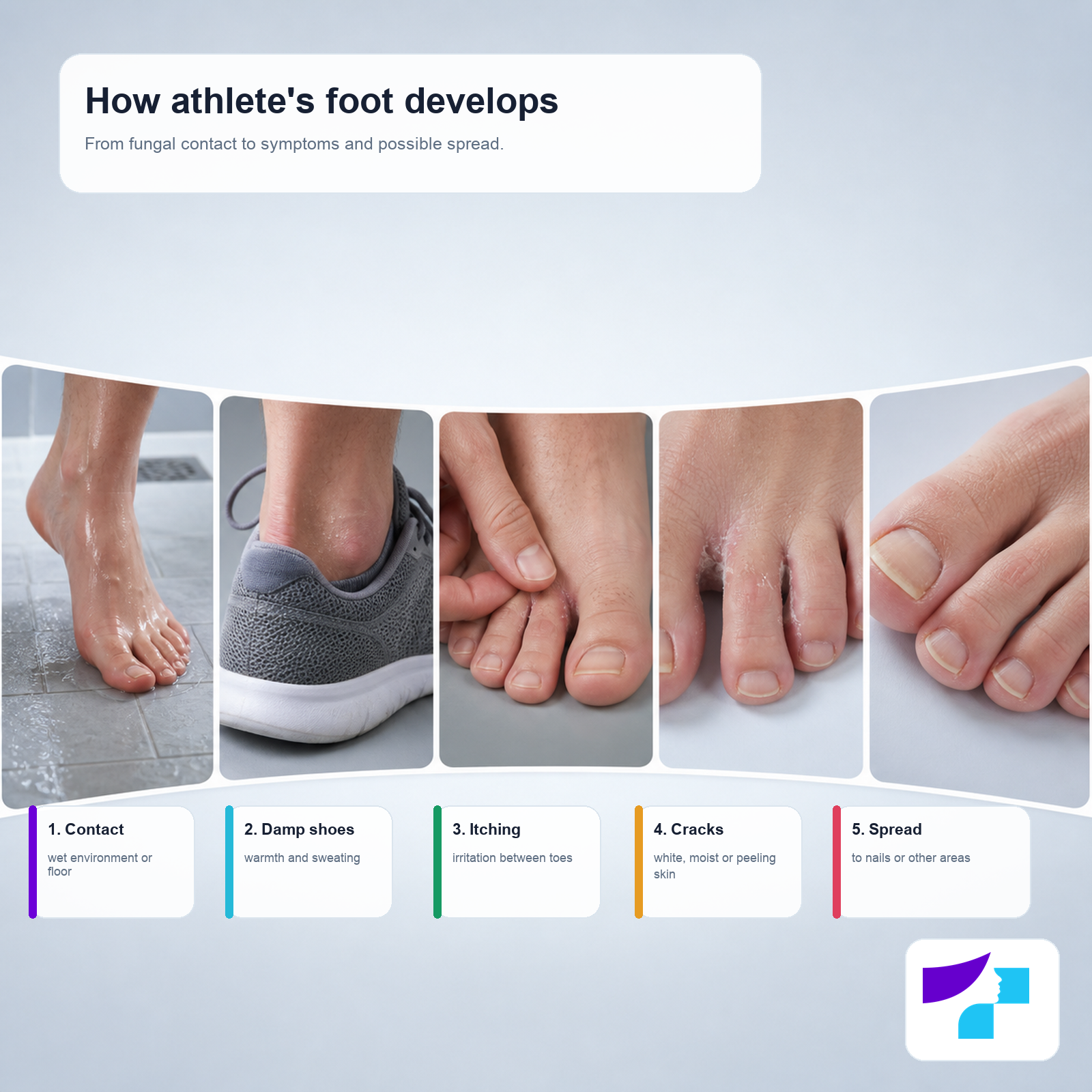 How athlete’s foot develops: fungal contact, damp shoes, itching, cracks and spread to nails or other areas