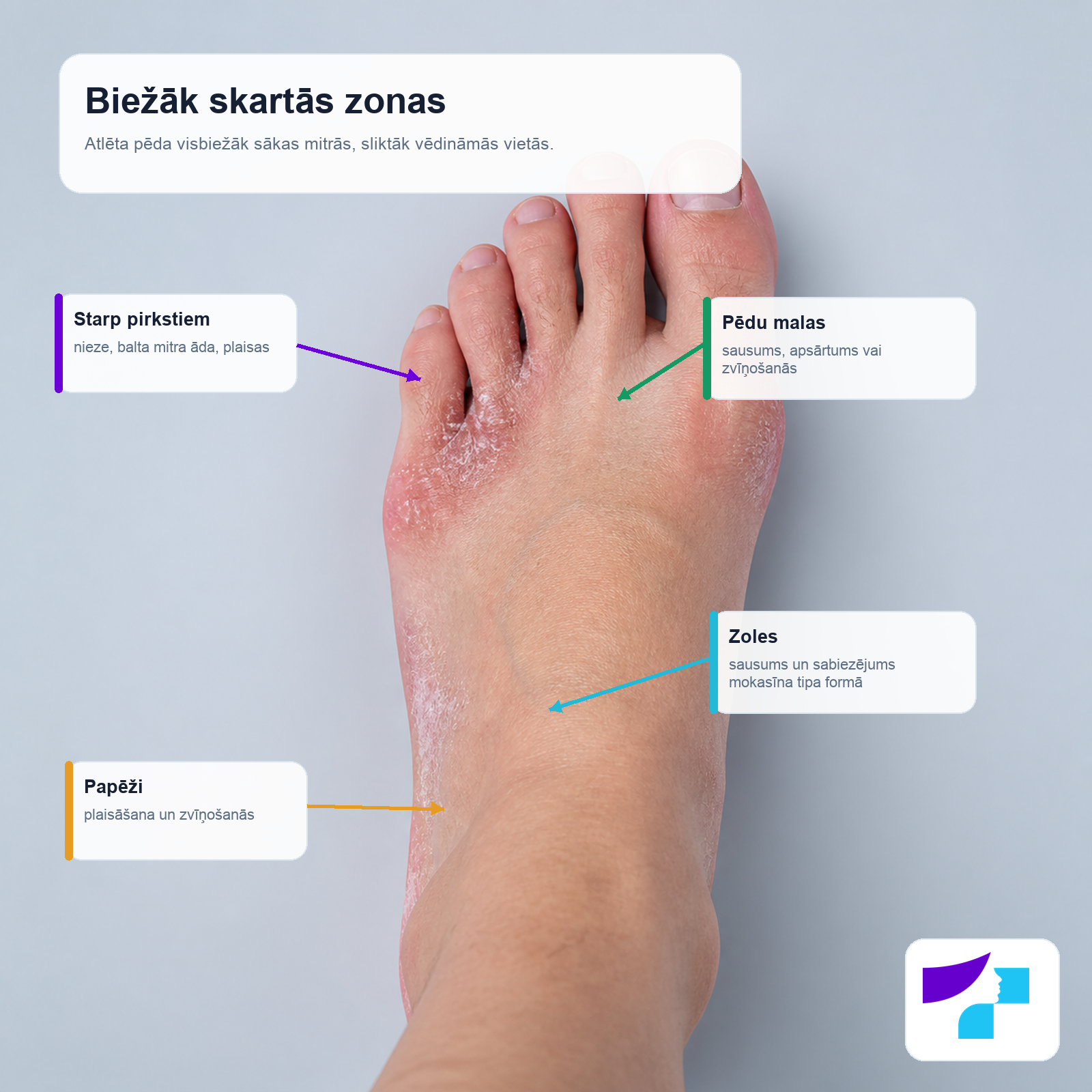 Atlēta pēdas biežāk skartās zonas: starp pirkstiem, pēdu malas, zoles un papēži