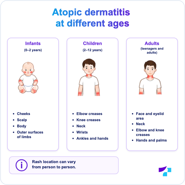 Atopic dermatitis at different ages Common locations of atopic dermatitis in infants, children and adults