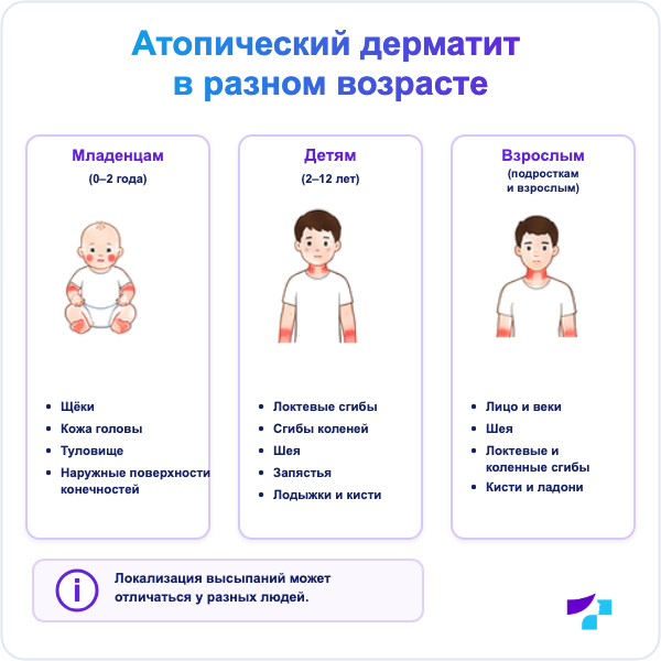 Частые зоны атопического дерматита у младенцев, детей и взрослых