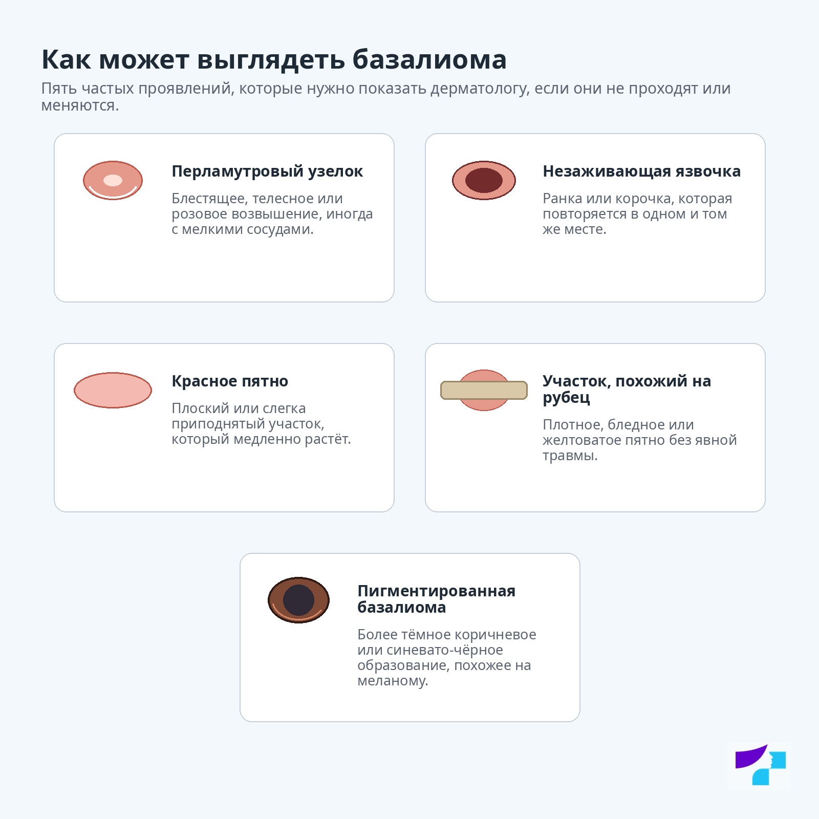 Как может выглядеть базалиома Типичные проявления базалиомы: перламутровый узелок, незаживающая язвочка, розовое пятно, участок, похожий на рубец, и пигментированная базалиома