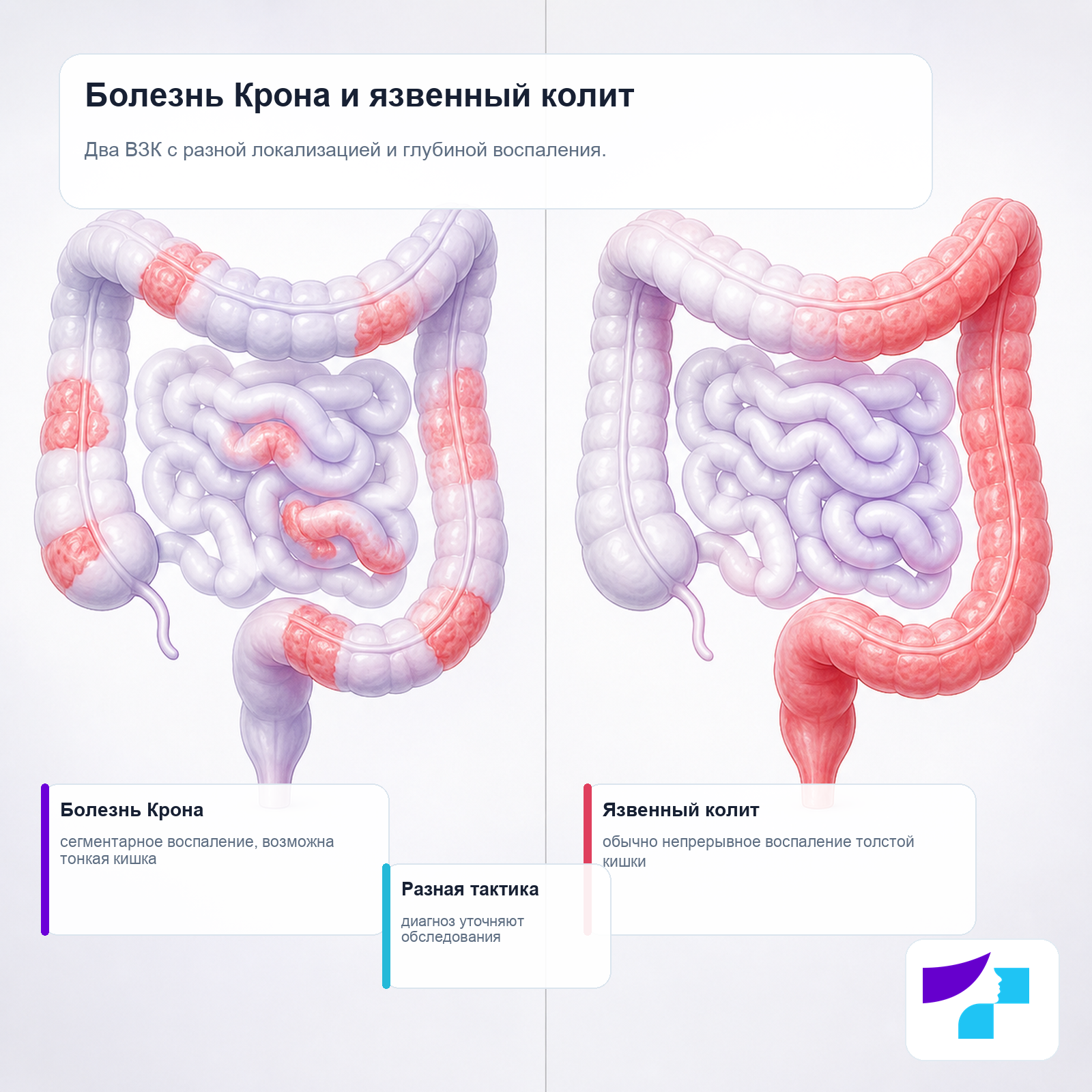 Болезнь Крона и язвенный колит: различия в локализации, распространенности и глубине воспаления