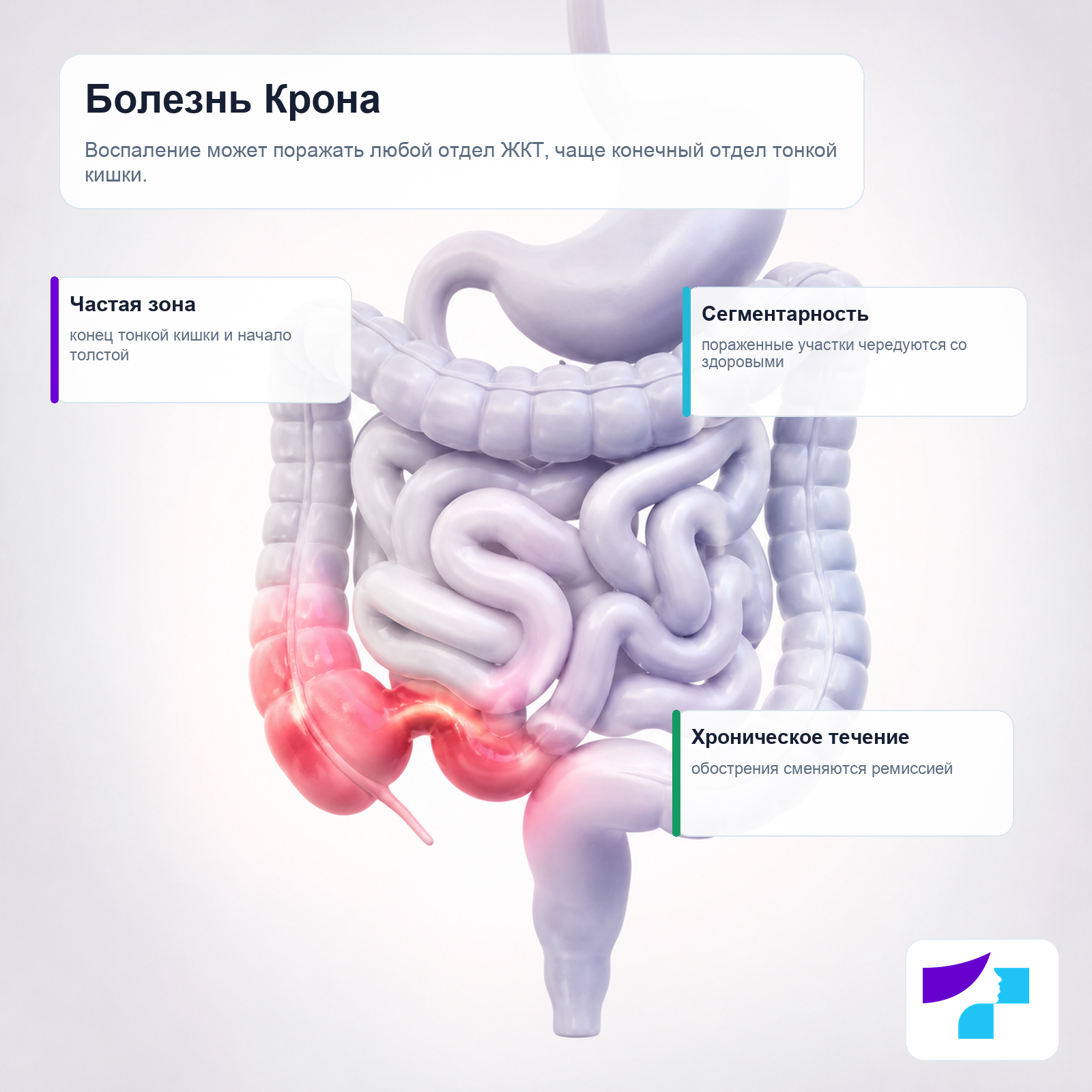 Болезнь Крона: воспаление может поражать пищеварительный тракт и чаще всего конечный отдел тонкой кишки