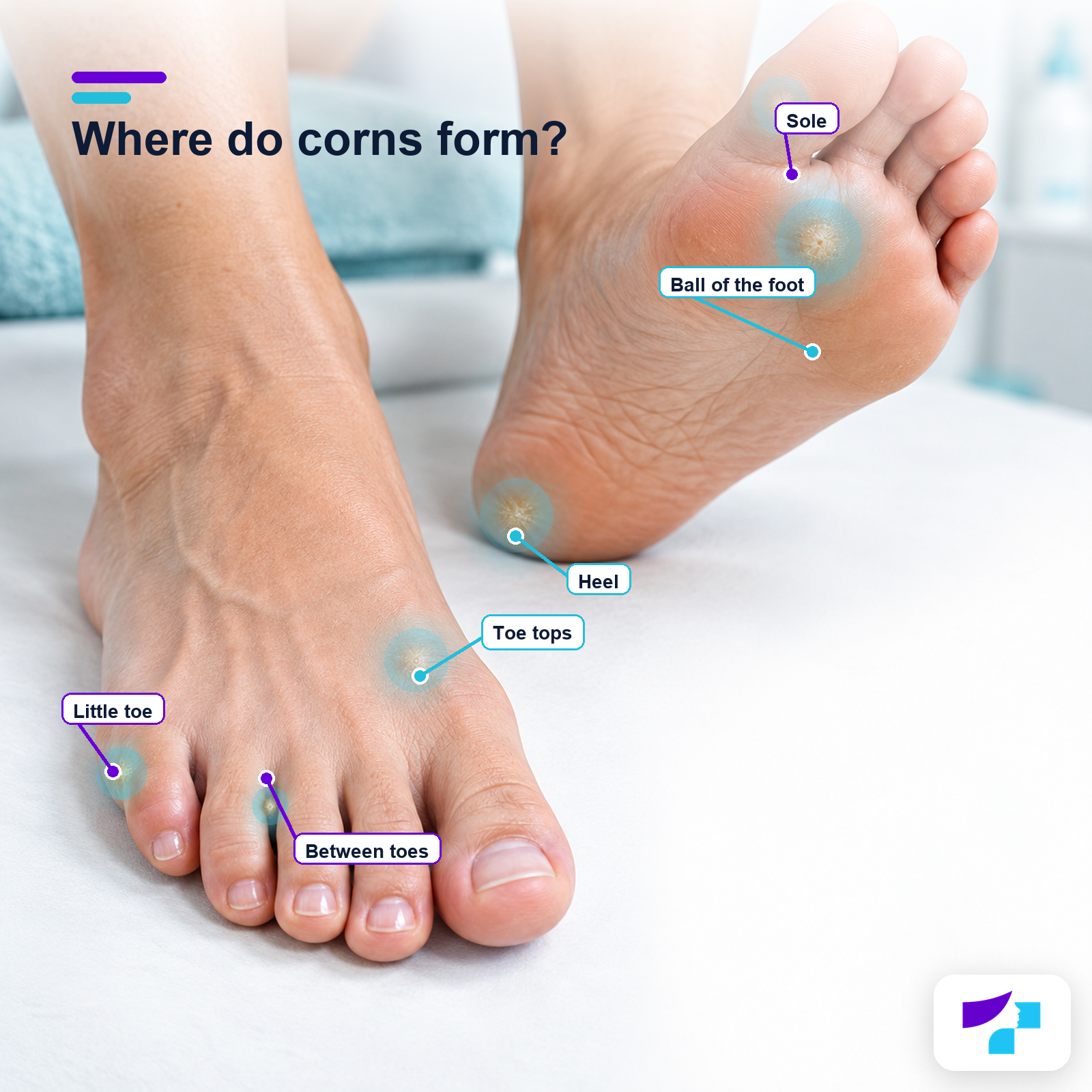 Common corn locations on the toes, sole, forefoot and heel