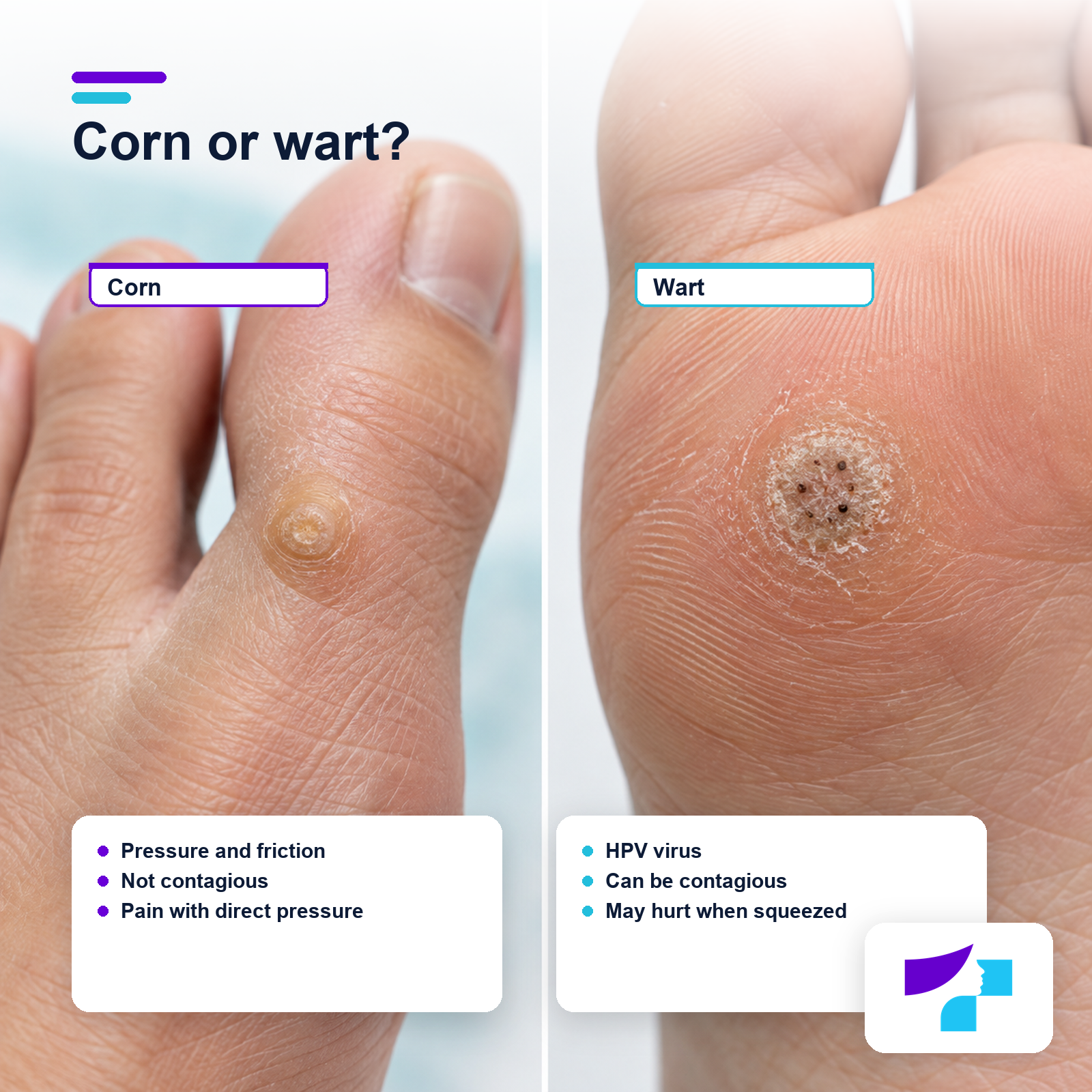 Differences between a corn and a wart on the foot by cause, contagiousness and pain pattern