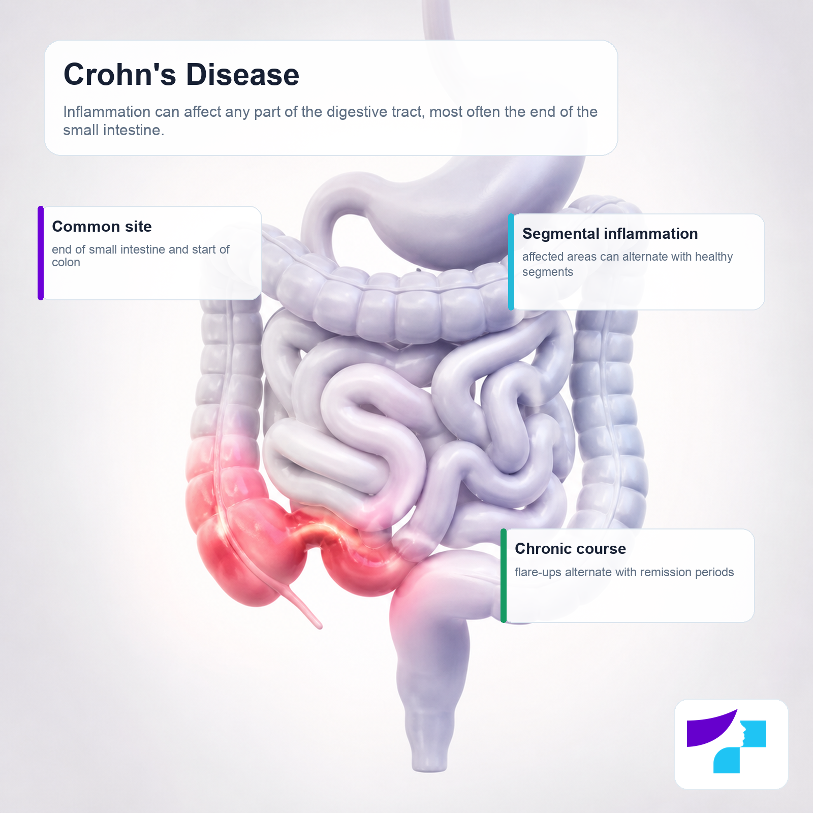 Crohn’s disease: inflammation can affect the digestive tract and most often involves the end of the small intestine