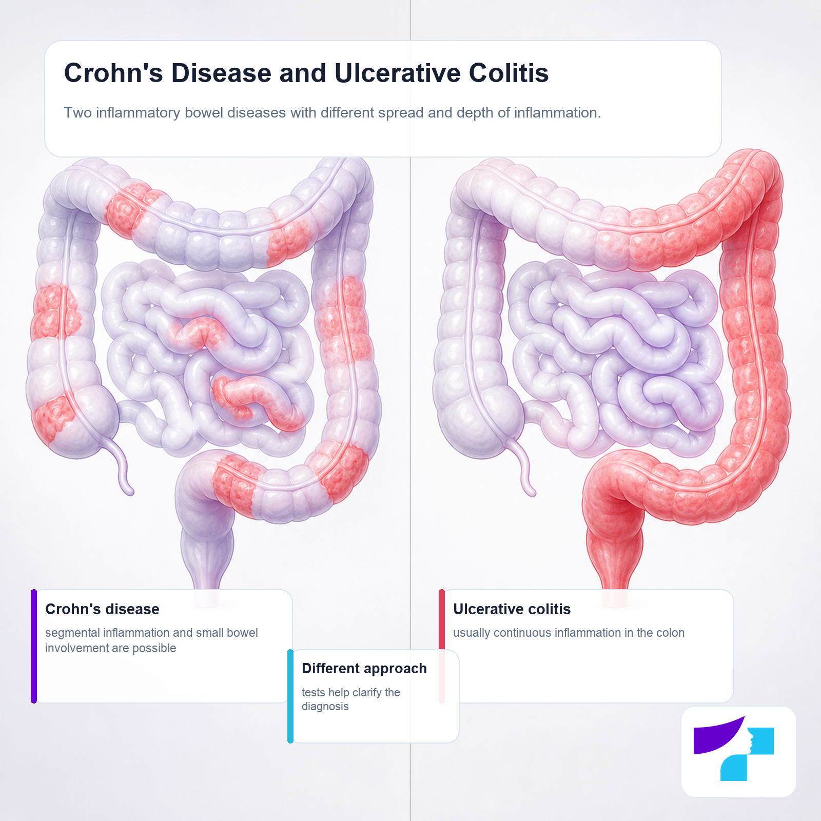 Crohn’s disease and ulcerative colitis: different inflammation location, spread and depth