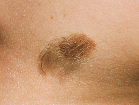 Hairy moles