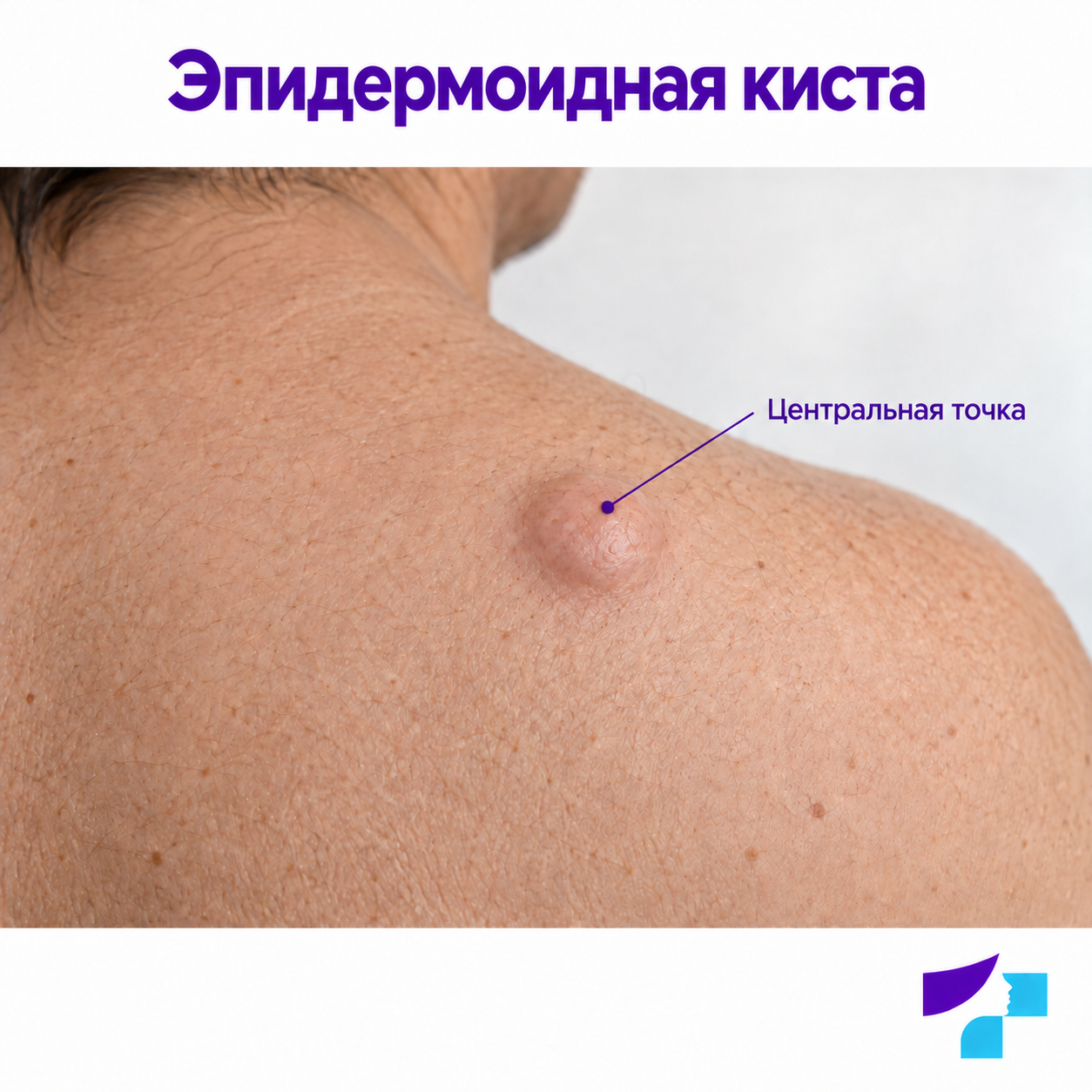 Эпидермоидная киста на коже: куполообразный узелок с центральной точкой
