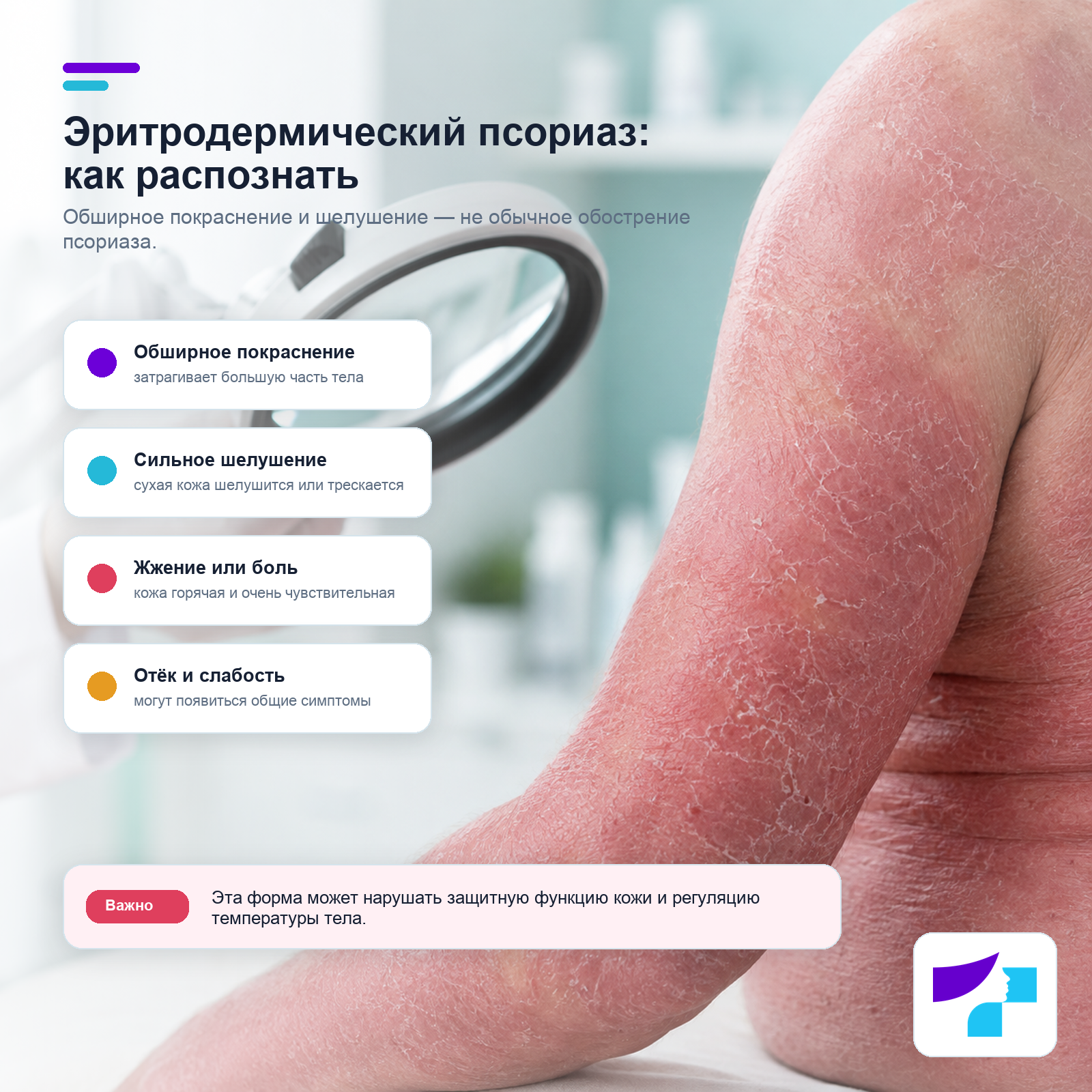 Эритродермический псориаз: обширное покраснение, сильное шелушение, жжение, боль, отёк и слабость