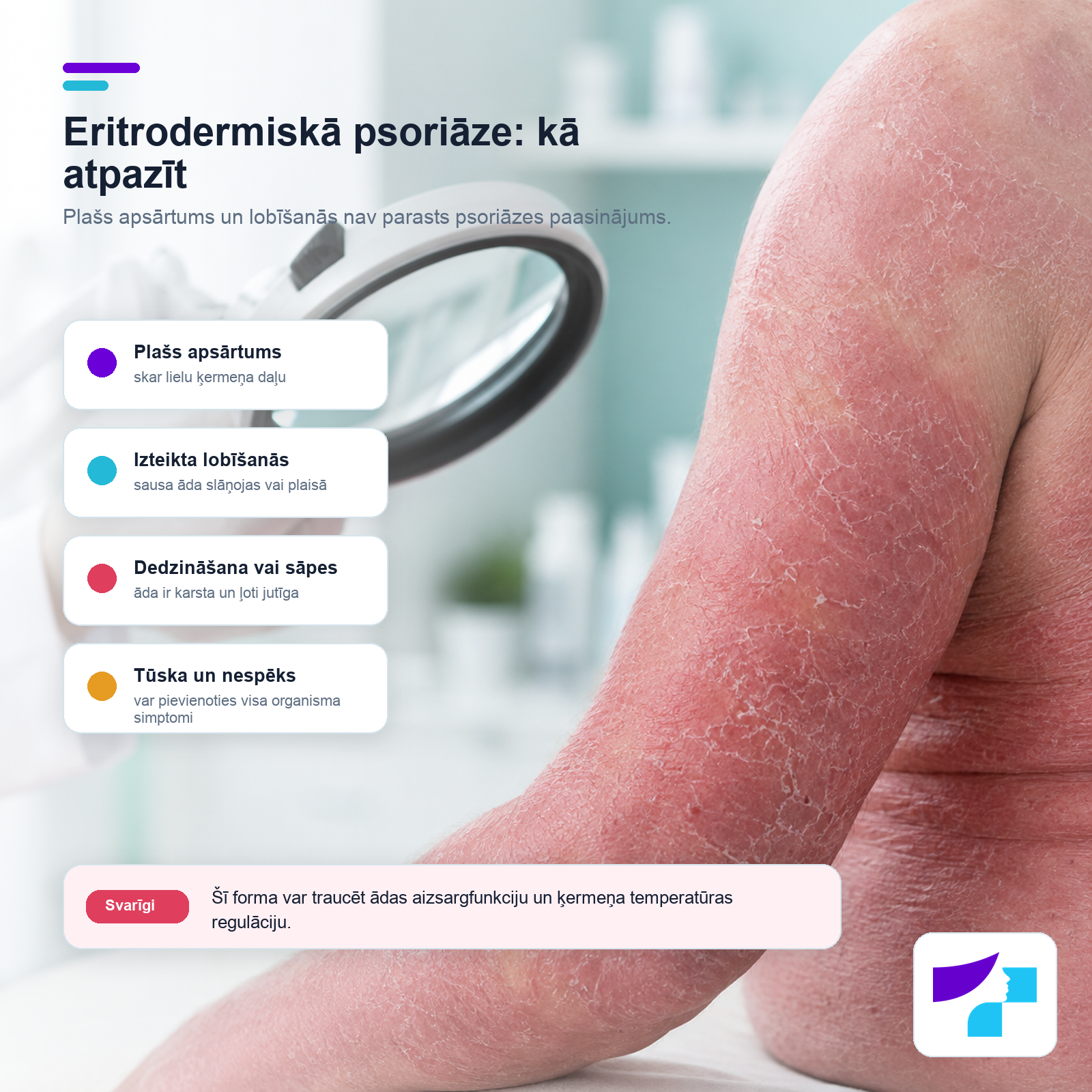 Eritrodermiskā psoriāze: kā atpazīt Eritrodermiskā psoriāze: plašs apsārtums, izteikta lobīšanās, dedzināšana, sāpes, tūska un nespēks
