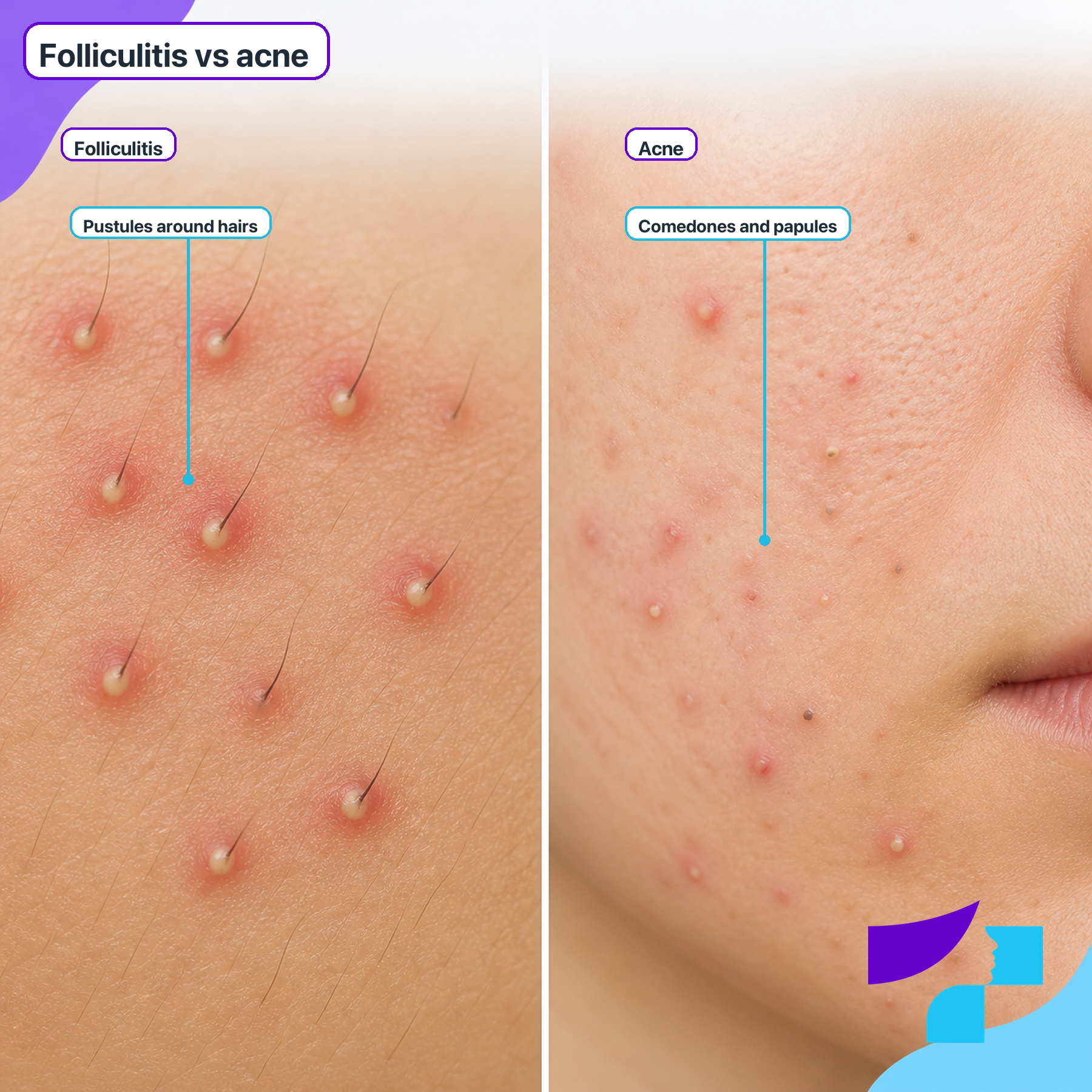 Folliculitis vs Acne Folliculitis versus acne: folliculitis causes pustules around hairs, while acne often includes comedones, papules and pustules