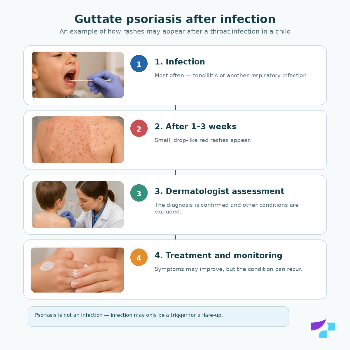 Guttate psoriasis in children after infection: throat infection or tonsillitis may trigger many small drop-like rashes