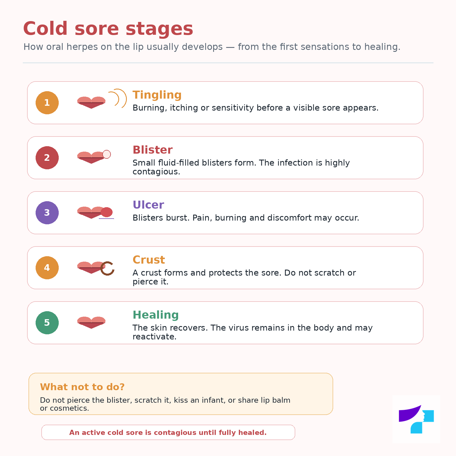 Cold sore stages Cold sore stages