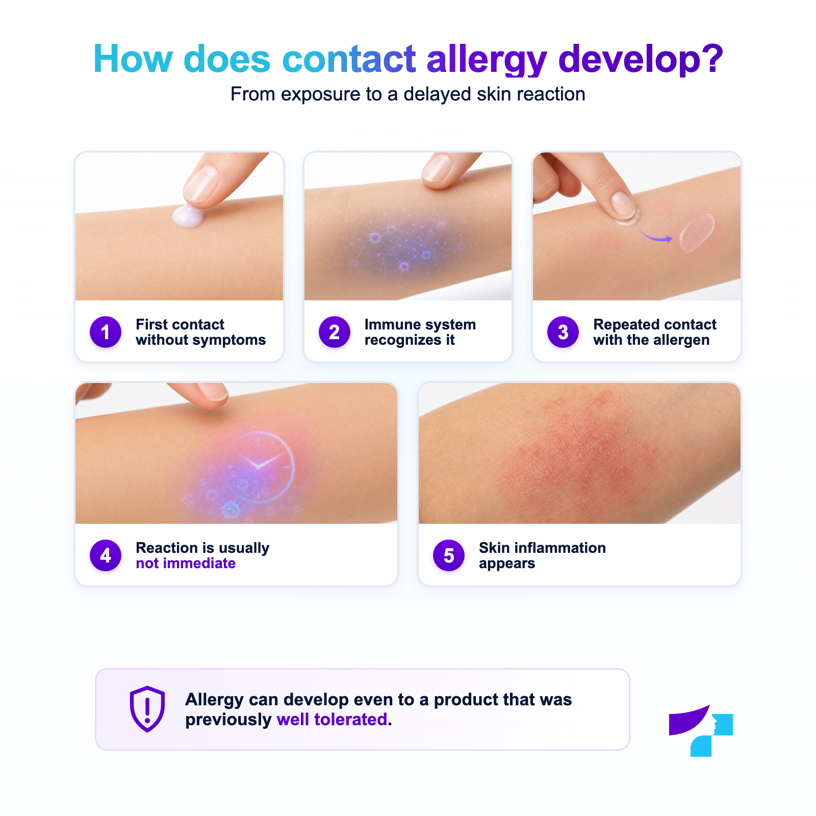 How contact allergy develops: sensitization, repeated exposure to an allergen and a delayed skin reaction