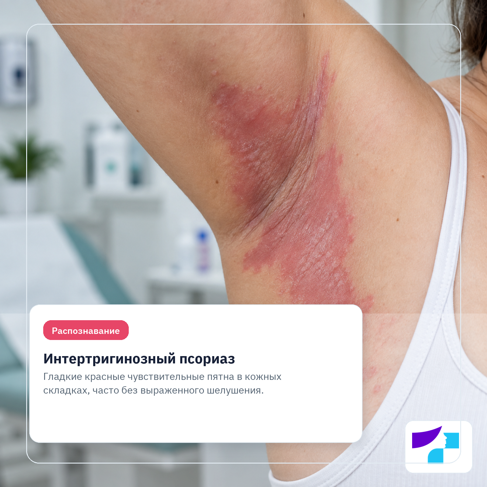 Интертригинозный псориаз: как распознать Интертригинозный псориаз: гладкие красные чувствительные пятна в кожных складках с менее заметным шелушением