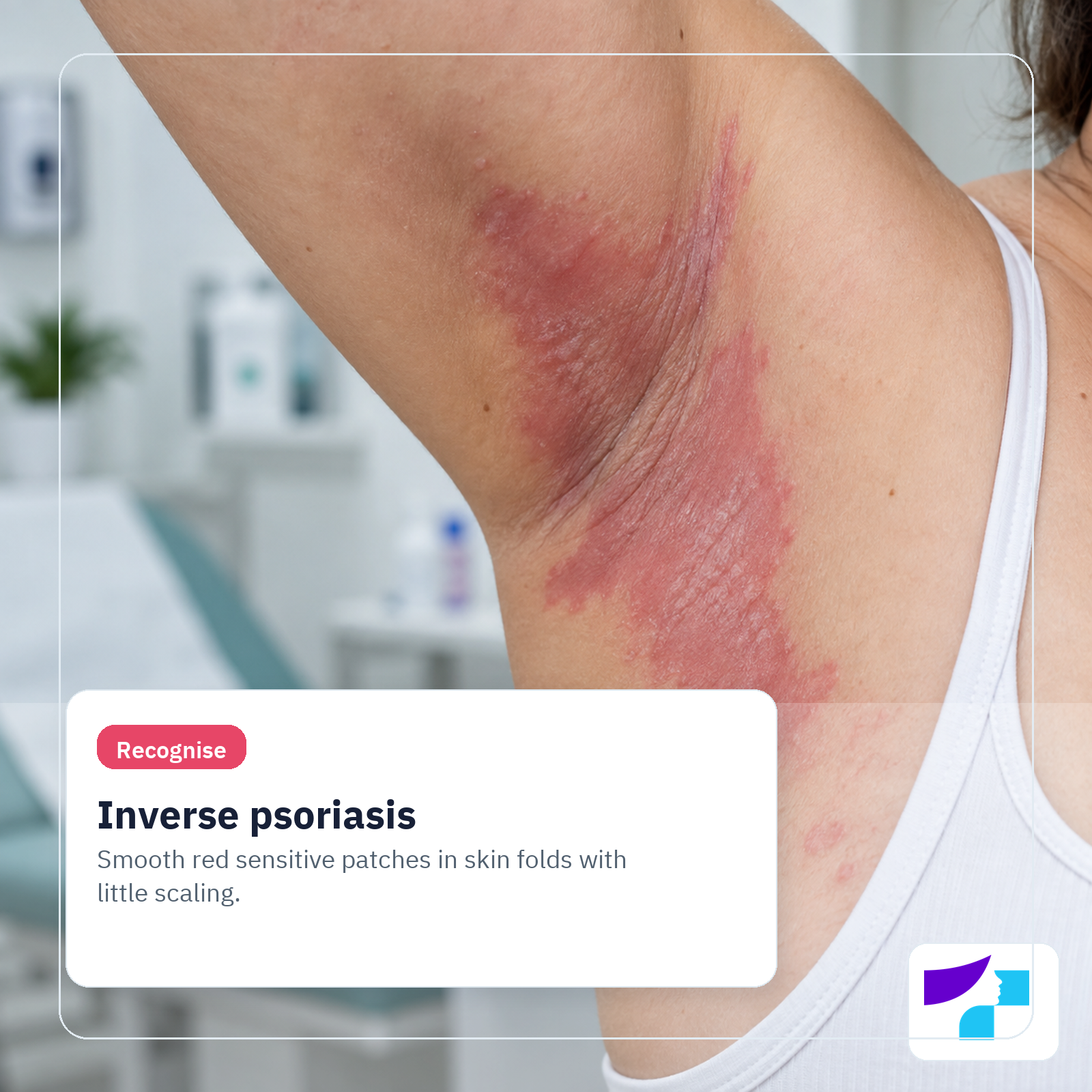 Inverse psoriasis: smooth, red, sensitive patches in skin folds with less visible scaling