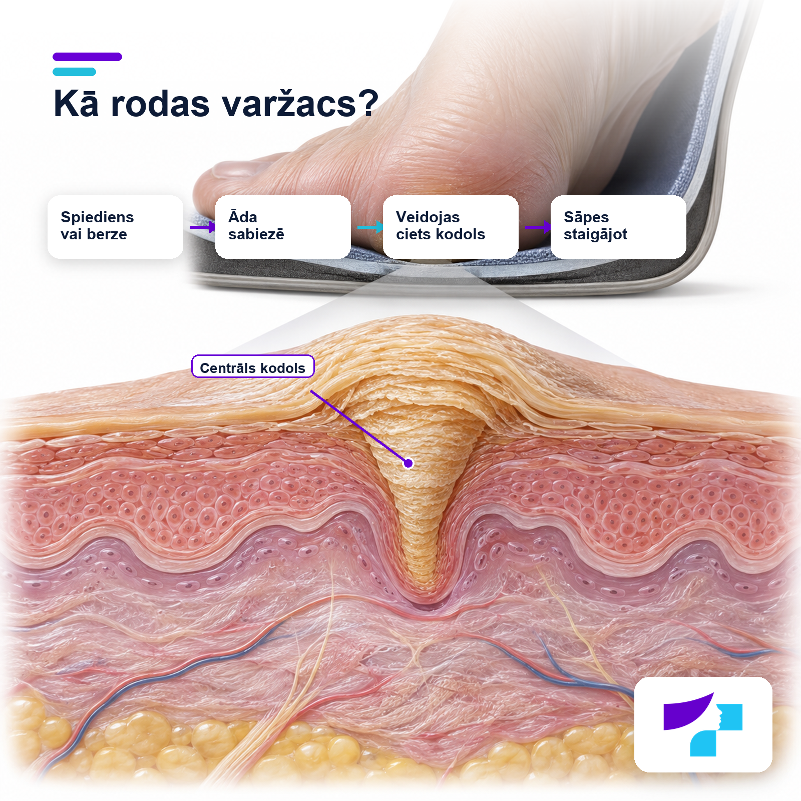 Cieta ādas sabiezējuma veidošanās uz pēdas spiediena un berzes dēļ