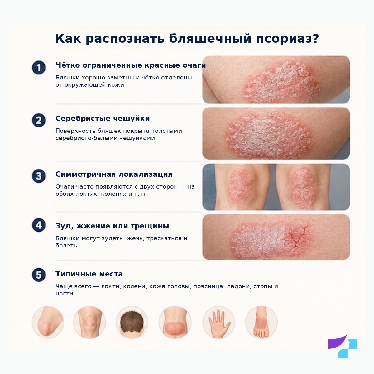 Как распознать бляшечный псориаз Как распознать бляшечный псориаз: чётко ограниченные красные очаги, сухие серебристые чешуйки, зуд, трещины и типичные места поражения