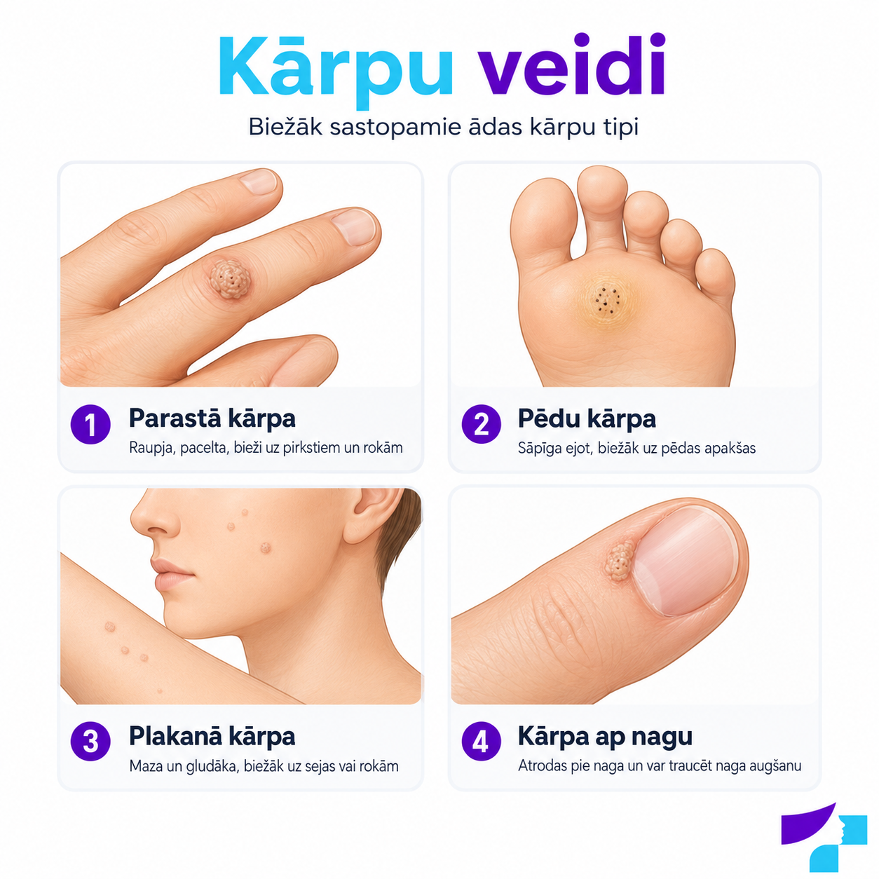 Kārpu veidi Biežākie kārpu veidi: parastās, pēdu, plakanās un ap nagu esošās kārpas