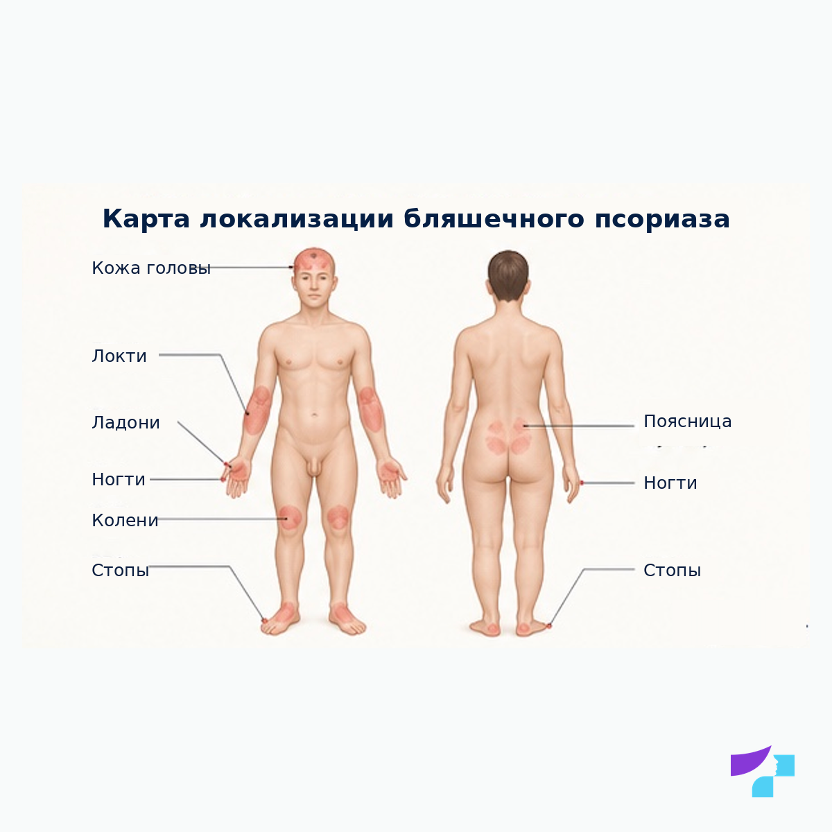 Карта локализации бляшечного псориаза Карта локализации бляшечного псориаза: локти, колени, кожа головы, поясница, ладони, стопы и ногти