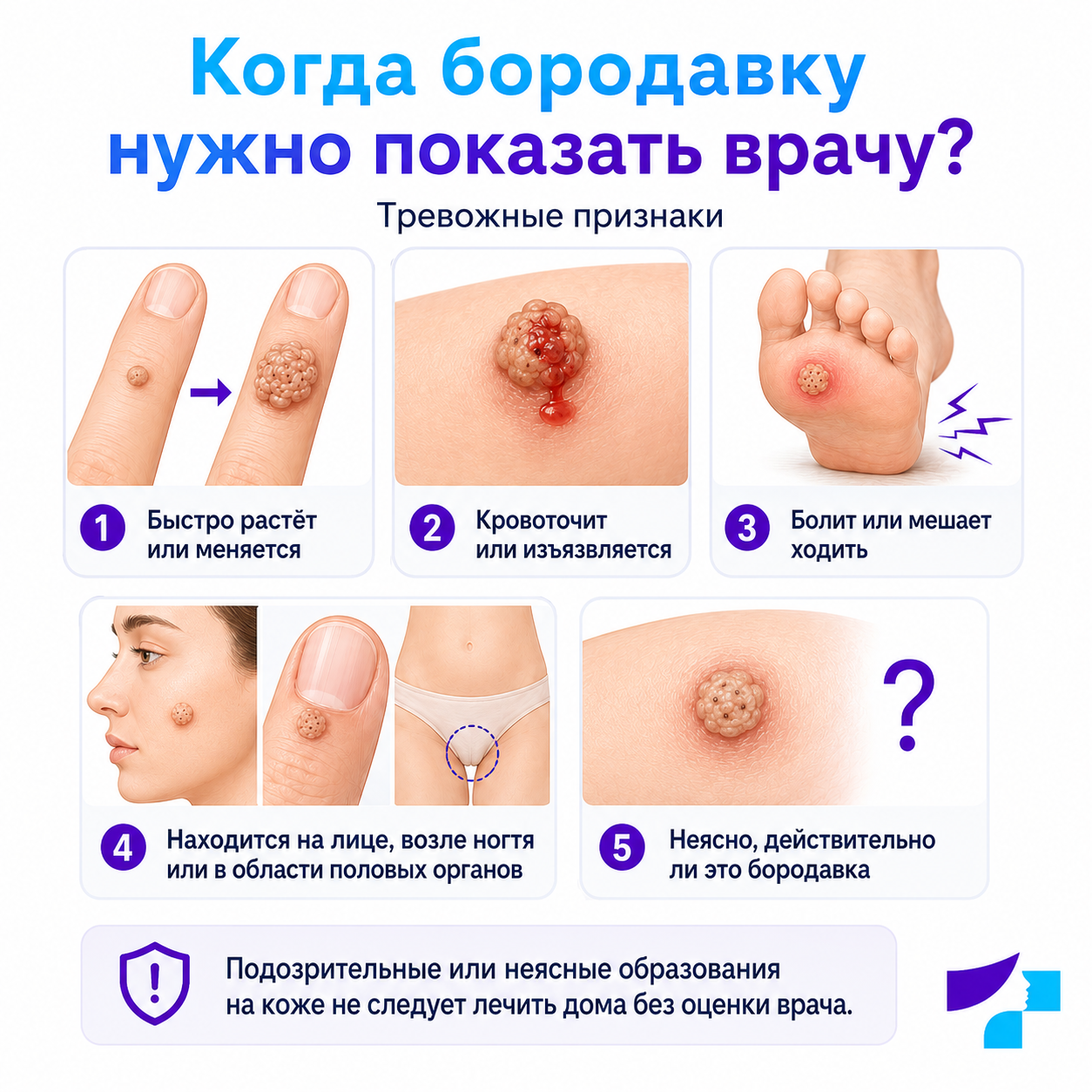 Когда бородавку нужно проверить Когда бородавку нужно проверить у дерматолога: быстрый рост, кровотечение, боль, расположение на лице, возле ногтя или в области половых органов и неясное образование