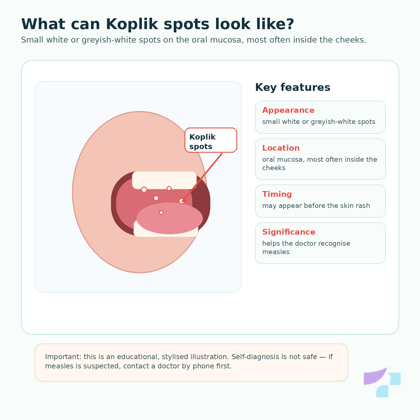 Koplik spots in measles: small white spots on the oral mucosa