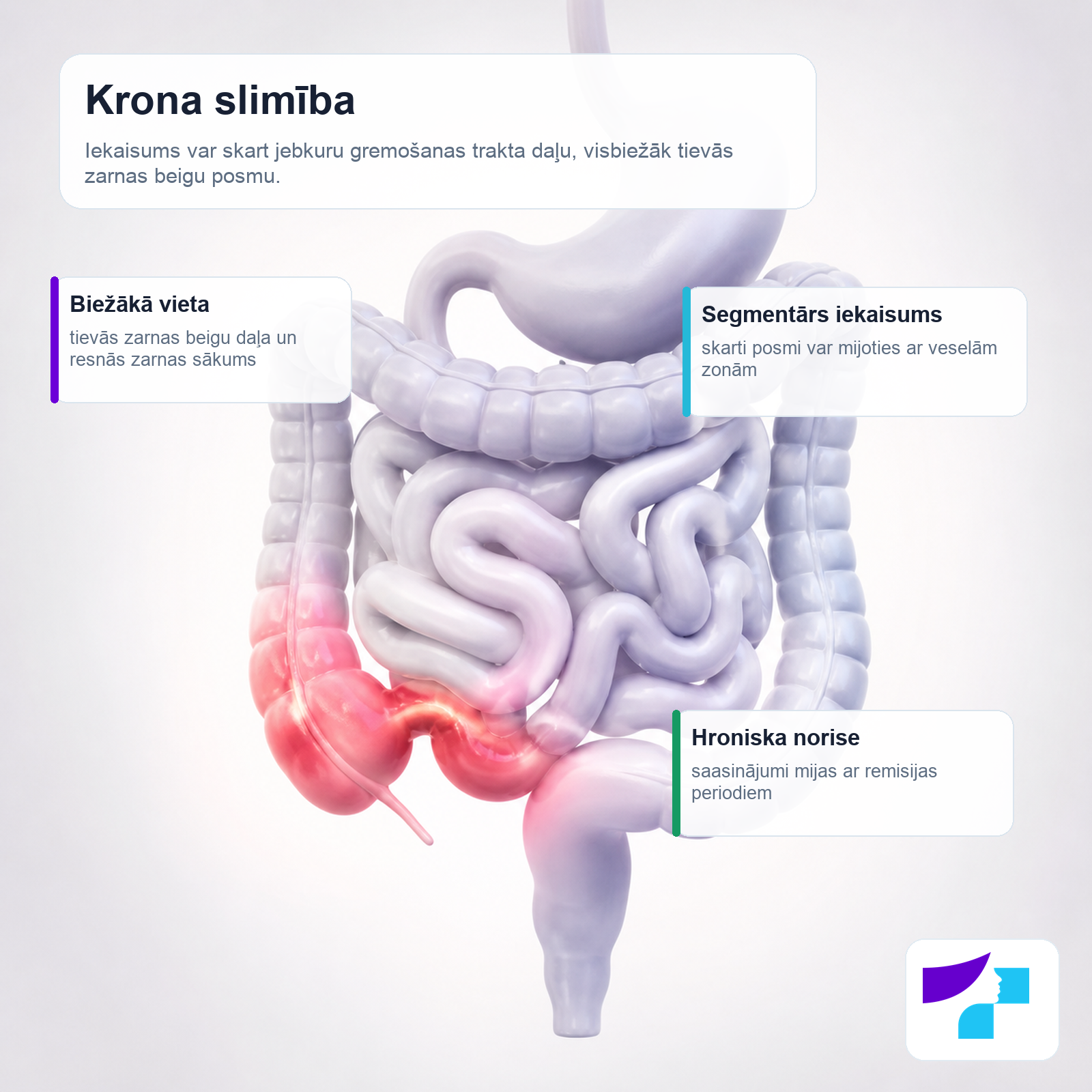 Krona slimība: iekaisums var skart gremošanas traktu un visbiežāk tievās zarnas beigu daļu