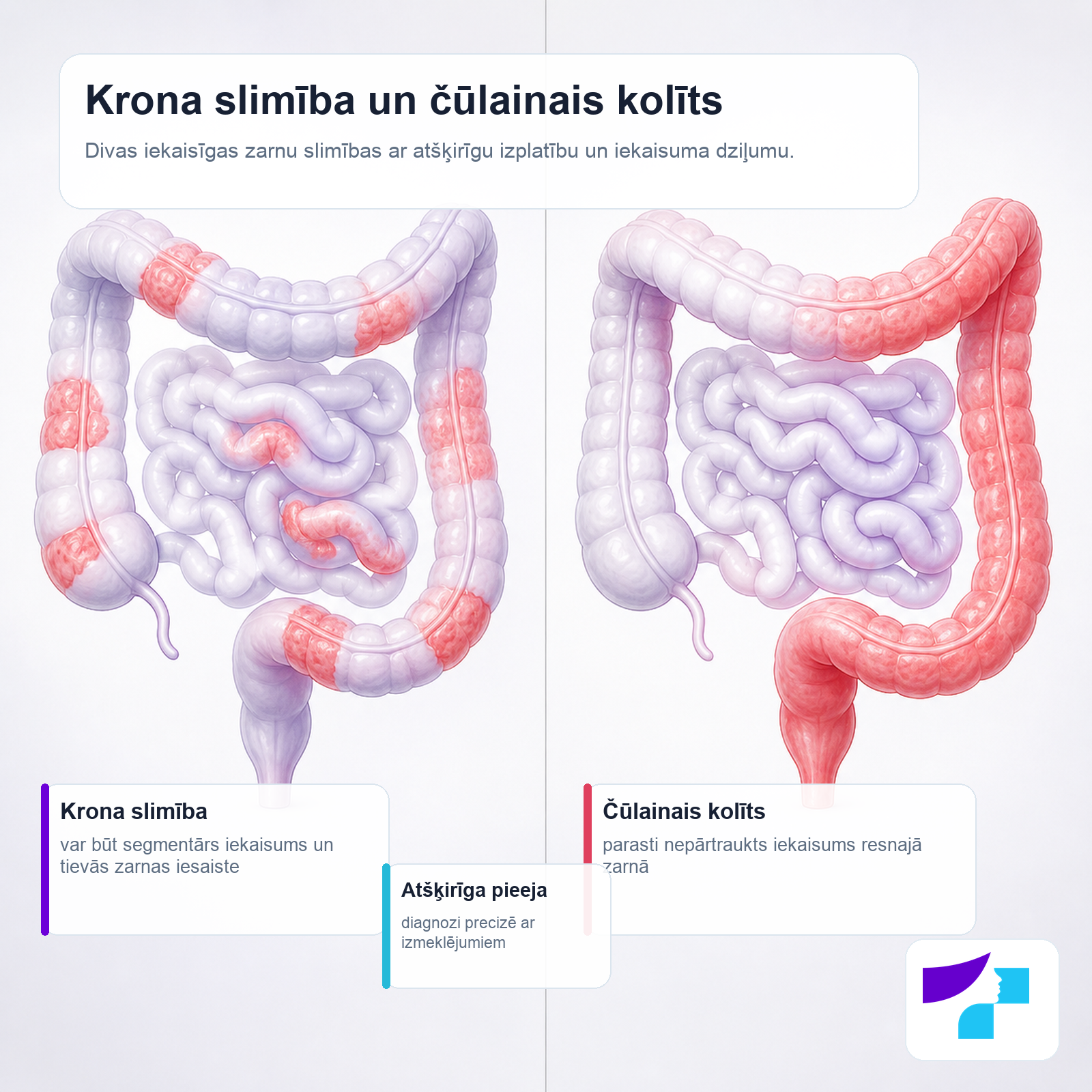 Krona slimība un čūlainais kolīts: atšķirīga iekaisuma lokalizācija, izplatība un dziļums