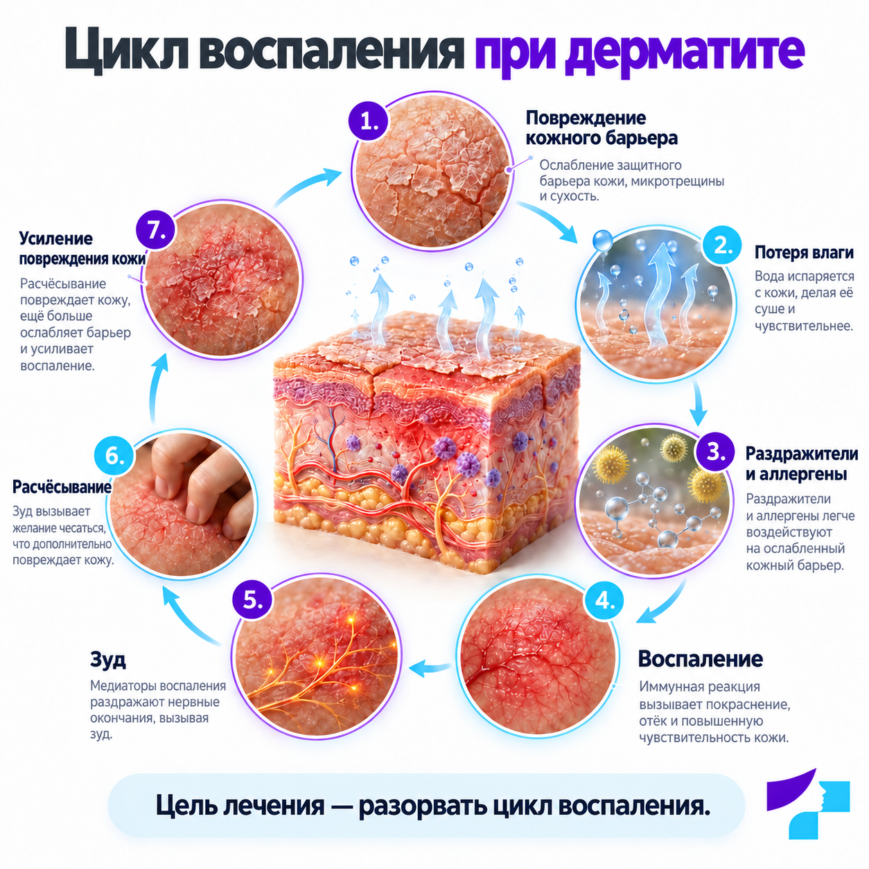 Цикл воспаления при дерматите Схема цикла воспаления при дерматите: повреждение кожного барьера, потеря влаги, воспаление, зуд и расчёсывание