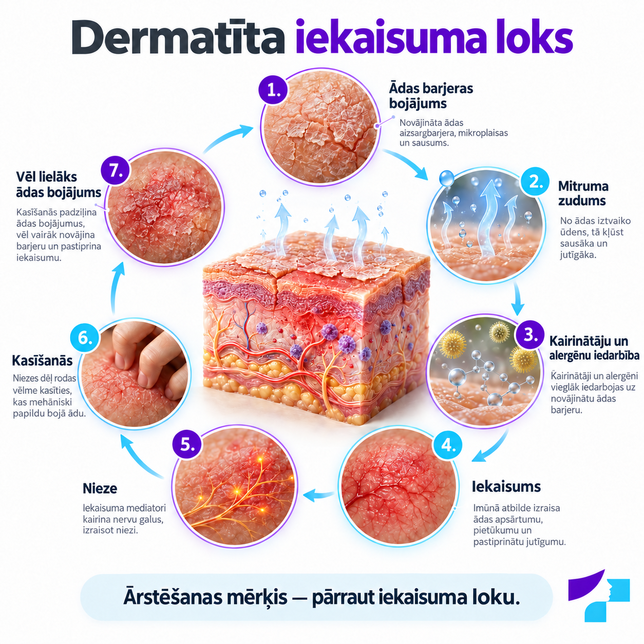 Dermatīta iekaisuma loks Dermatīta attīstības mehānisma shēma ar ādas barjeras bojājumu un iekaisuma loku