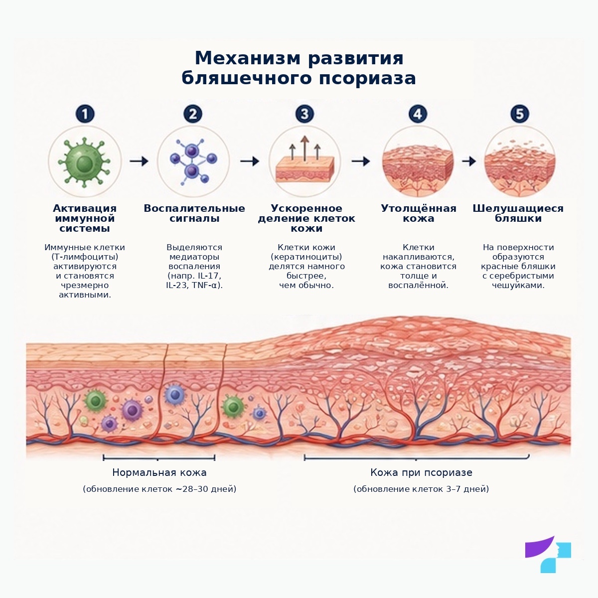 Механизм развития бляшечного псориаза Механизм развития бляшечного псориаза: активация иммунной системы, воспалительные сигналы, ускоренное деление клеток кожи, утолщение кожи и сухие чешуйки
