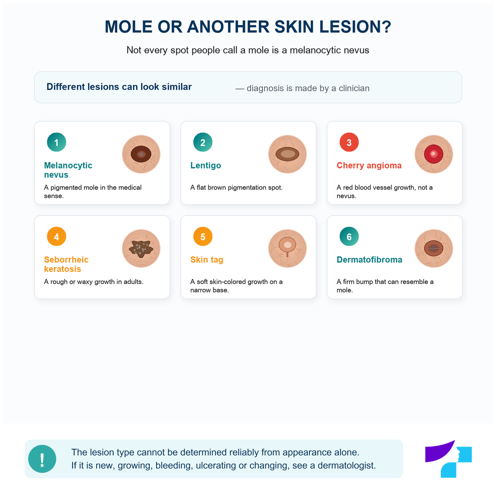 Mole or another skin lesion