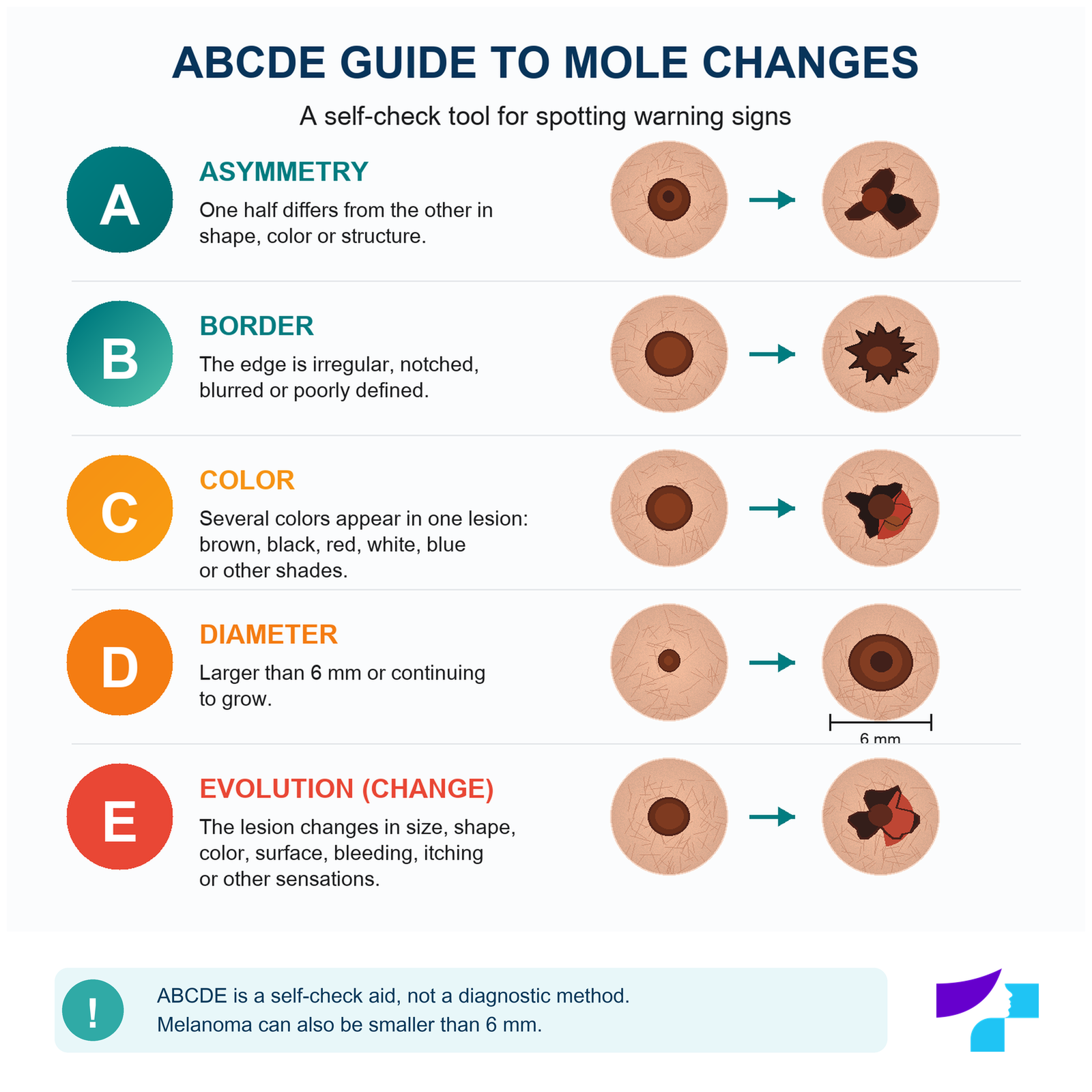 ABCDE rule for moles: asymmetry, borders, colour, diameter and evolution