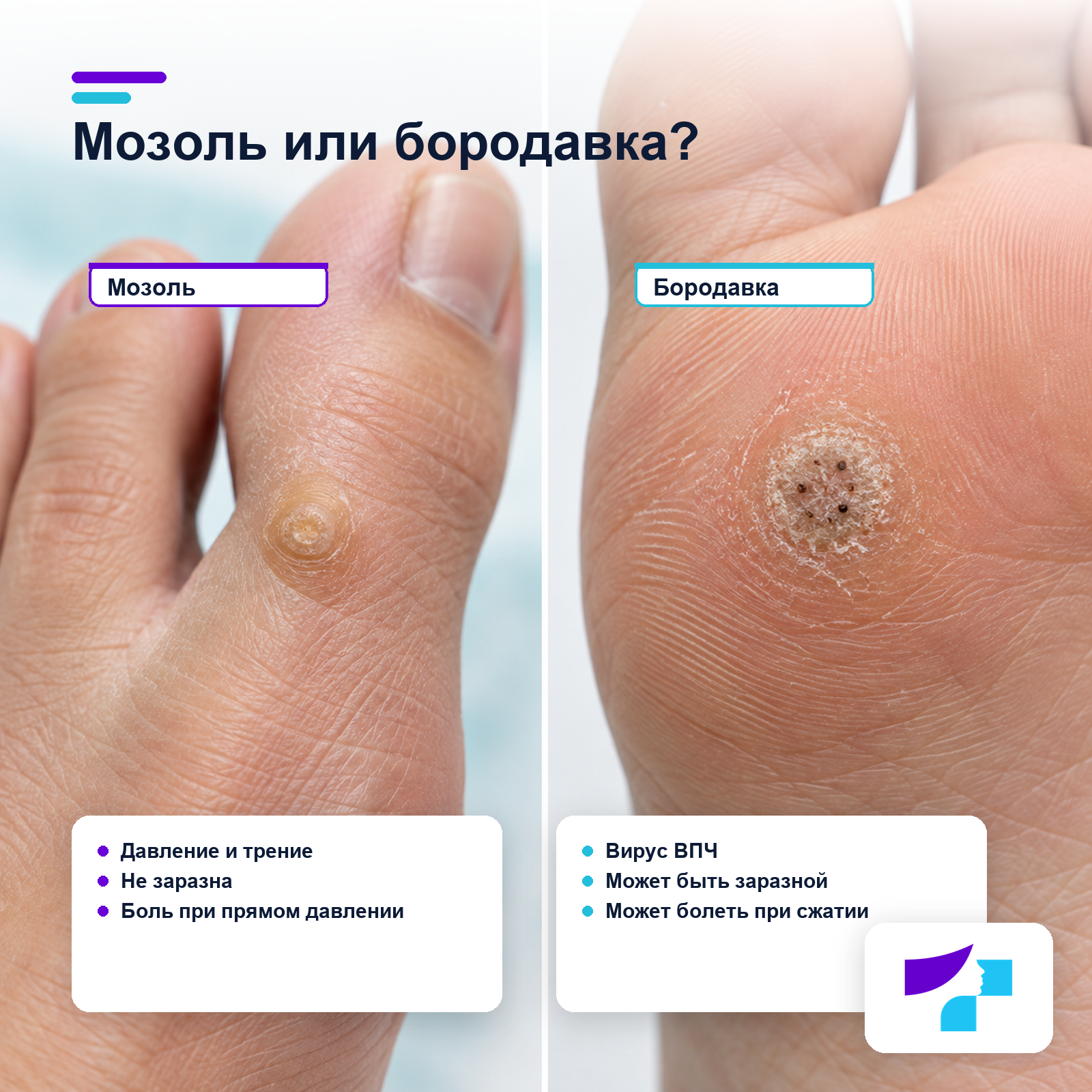 Отличия мозоли и бородавки на стопе по причине, заразности и характеру боли