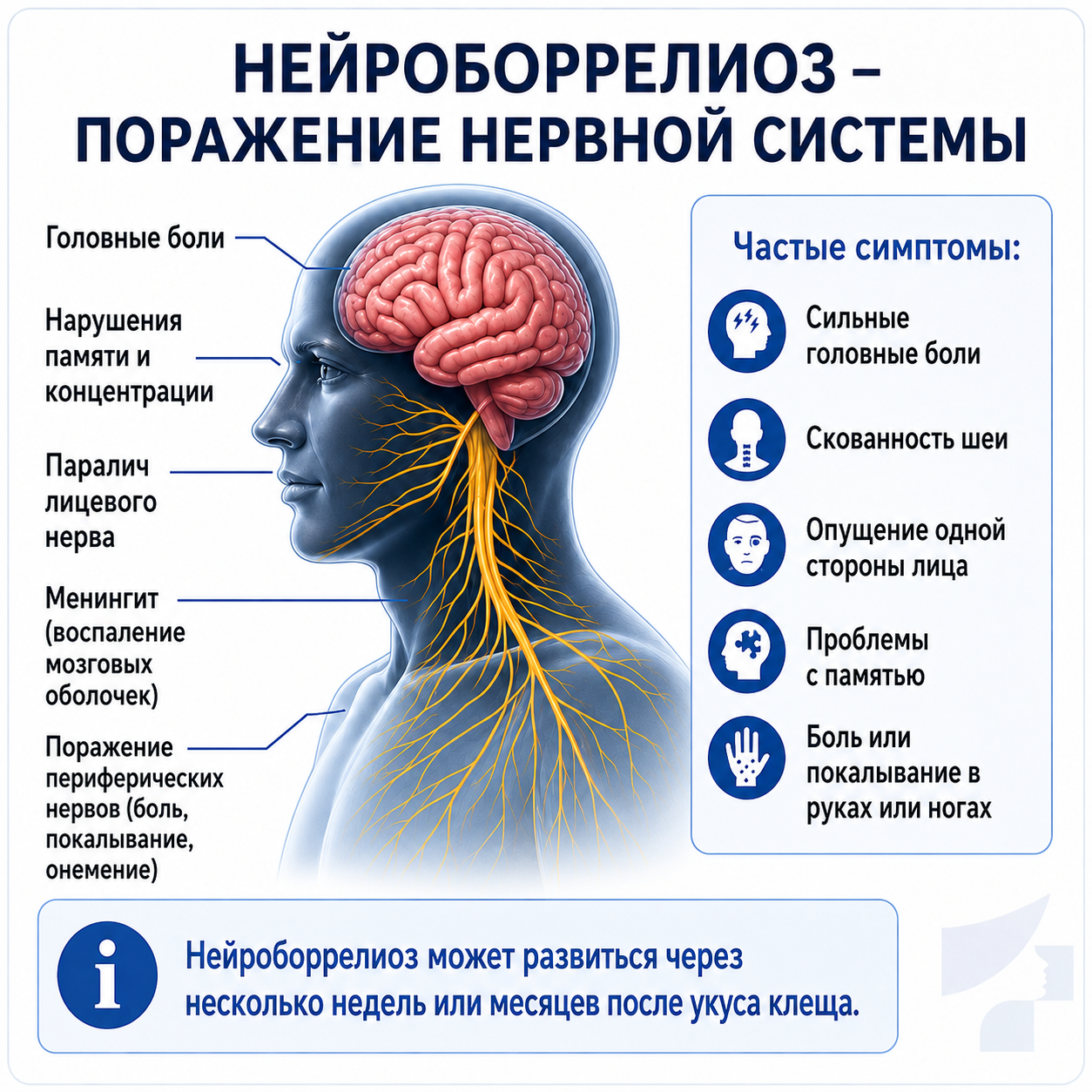 Иллюстрация нейроборрелиоза