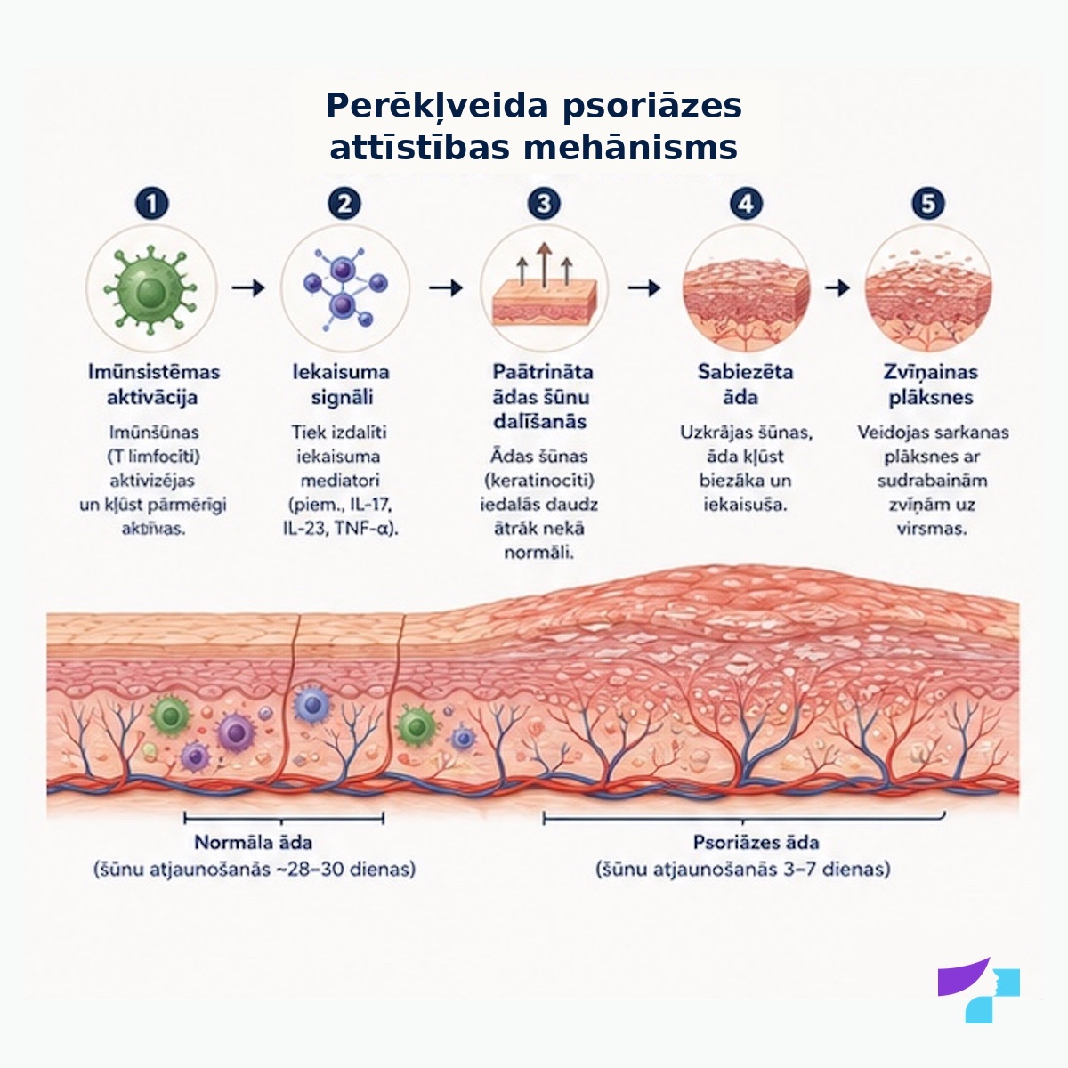 Perēkļveida psoriāzes attīstības mehānisms: imūnsistēmas aktivācija, iekaisuma signāli, paātrināta ādas šūnu dalīšanās, ādas sabiezēšana un sausas zvīņas