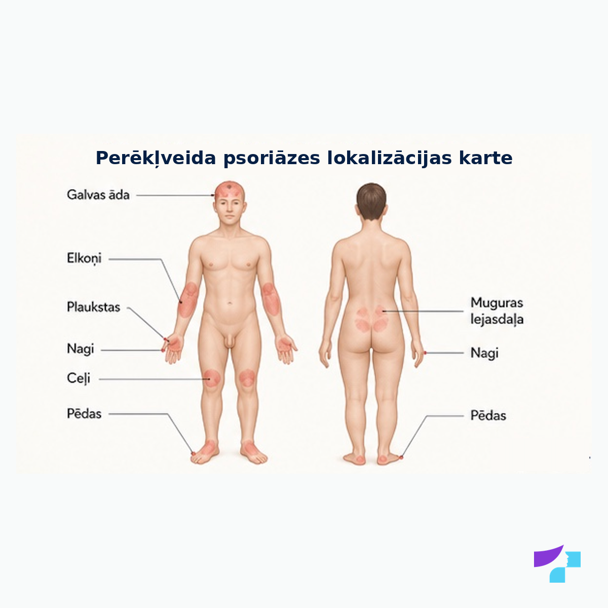Perēkļveida psoriāzes lokalizācijas karte: elkoņi, ceļi, galvas āda, muguras lejasdaļa, plaukstas, pēdas un nagi