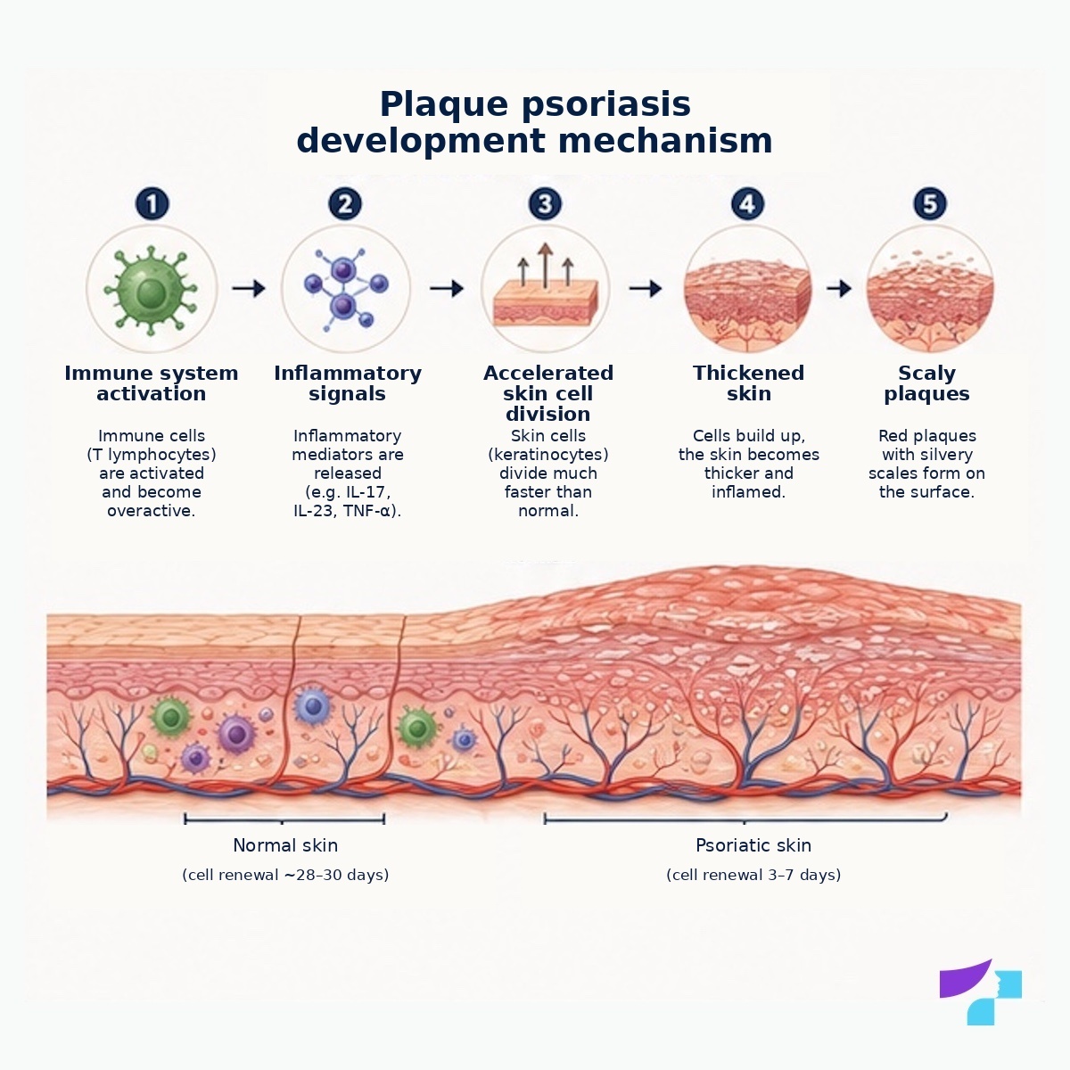 Plaque psoriasis development mechanism Plaque psoriasis development mechanism: immune system activation, inflammatory signals, accelerated skin cell division, skin thickening and dry scales