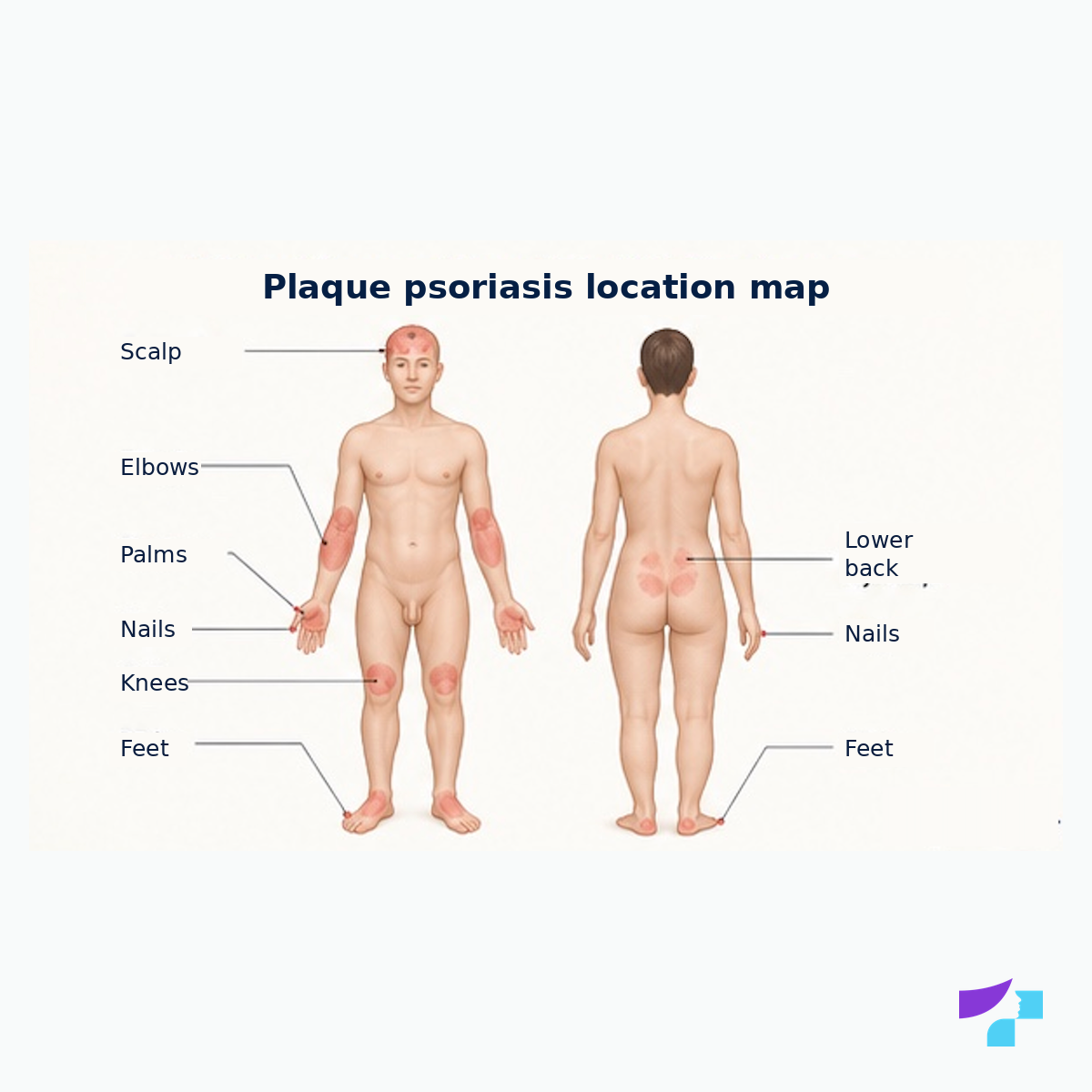 Plaque psoriasis location map Plaque psoriasis location map: elbows, knees, scalp, lower back, palms, soles and nails