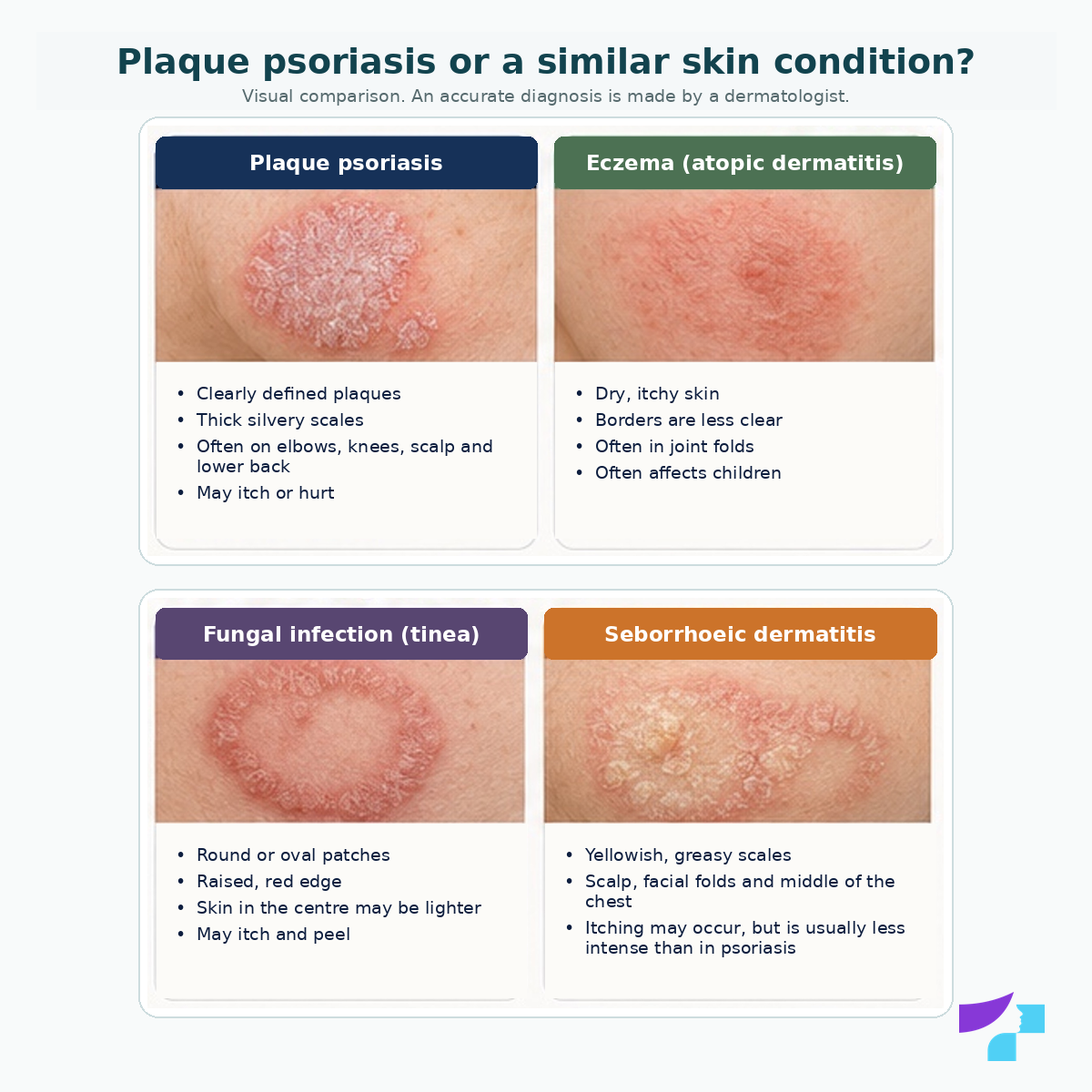 Plaque psoriasis or a similar skin condition Plaque psoriasis or a similar skin condition: comparison with eczema, fungal infection and seborrhoeic dermatitis