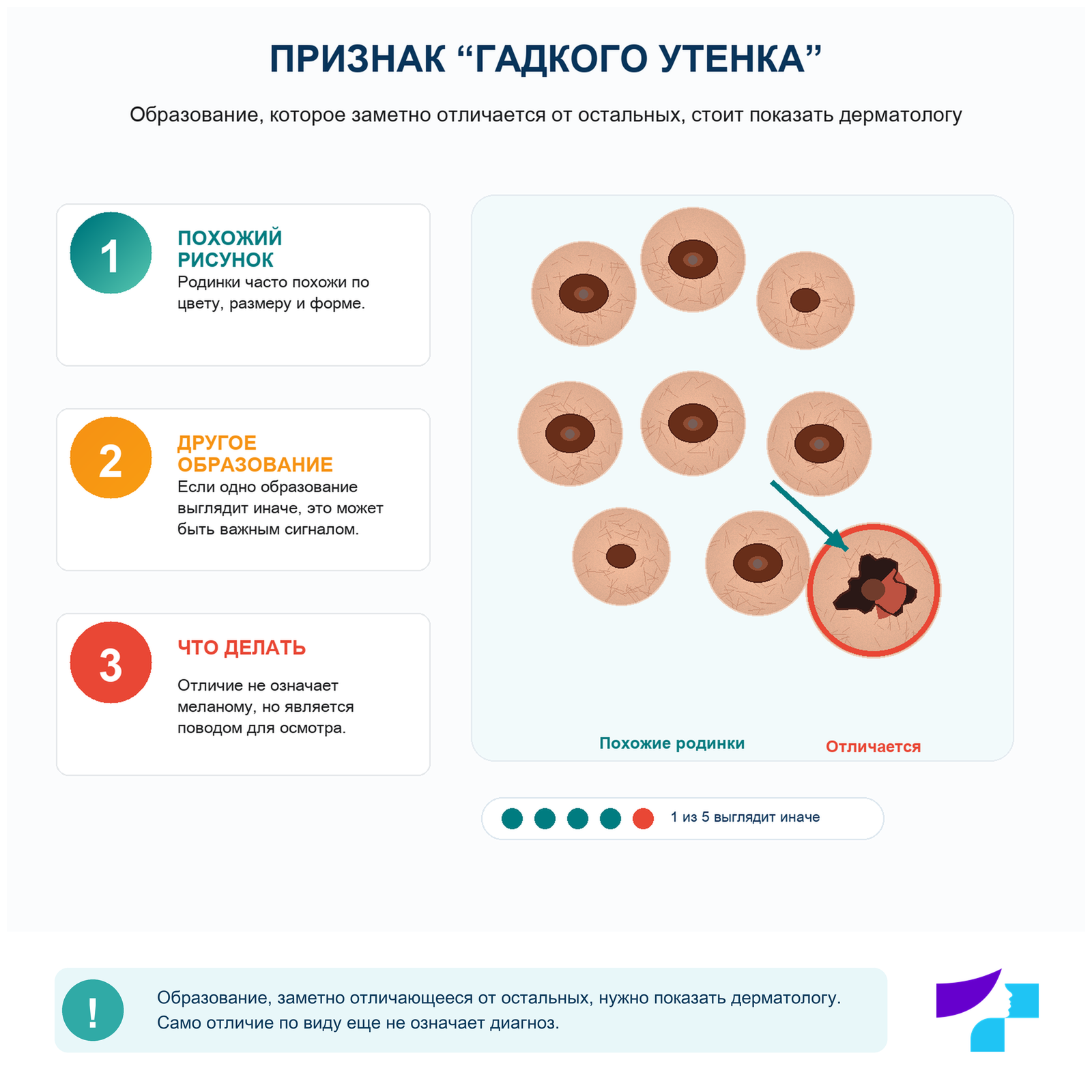 Признак гадкого утенка при осмотре родинок